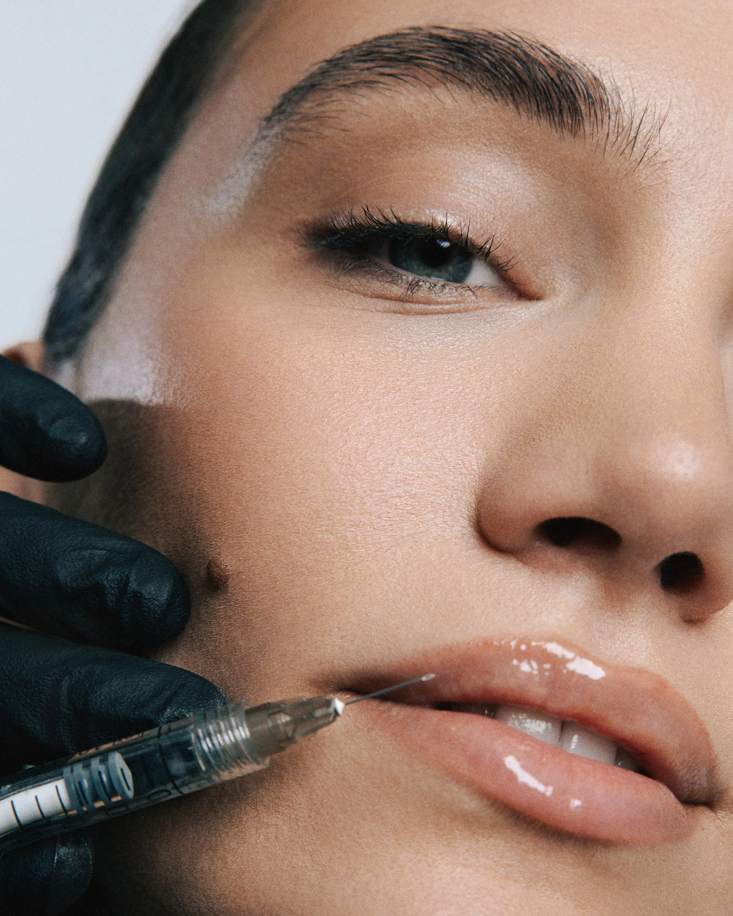 Close-up of a person's face receiving an injectable cosmetic treatment near the lower lip, with a hand in a black glove holding a syringe.