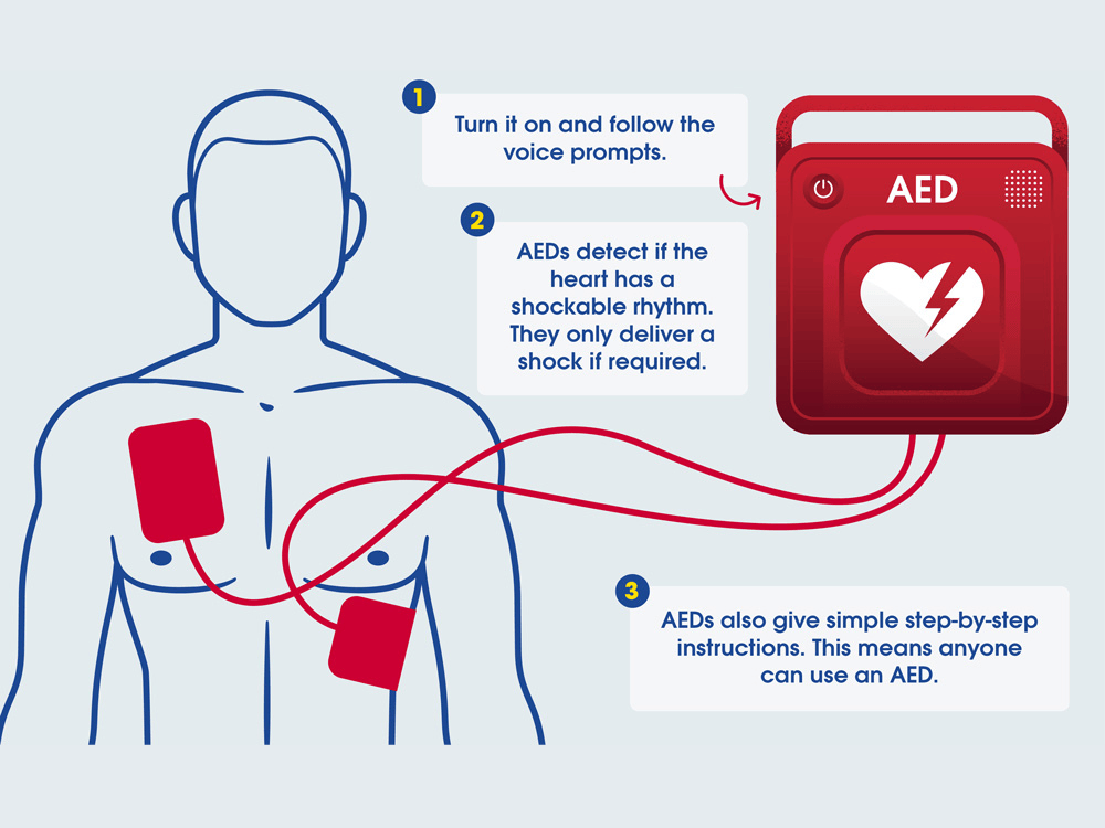 Diagram of an automatic external defibrillator (AED) connected to a person's chest with two pads, illustrating how an AED detects heart rhythm and delivers shock if needed, with numbered instructions for use.