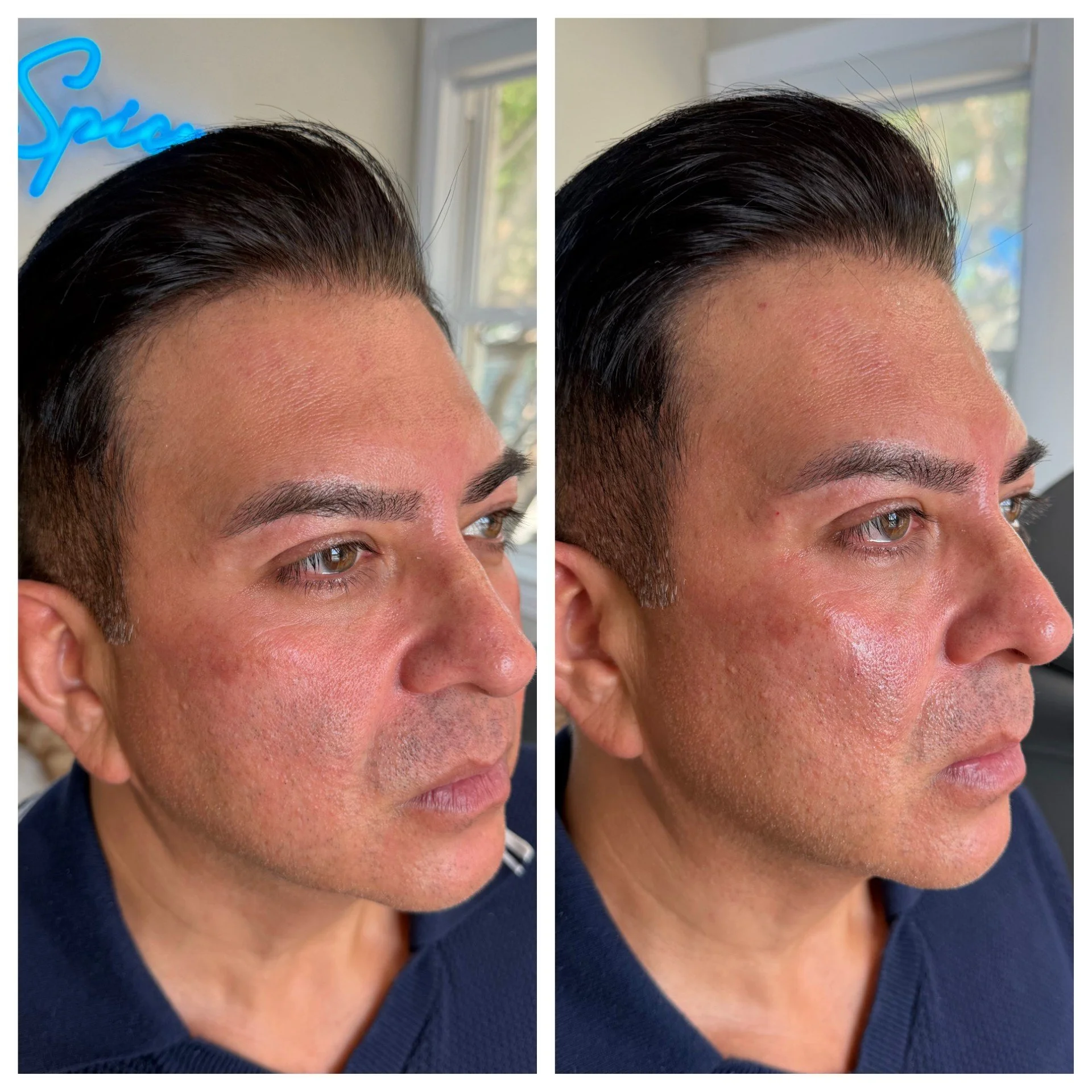 Side-by-side comparison of a man's hairline before and after a hair restoration procedure, showing increased hair density and improved hairline appearance.