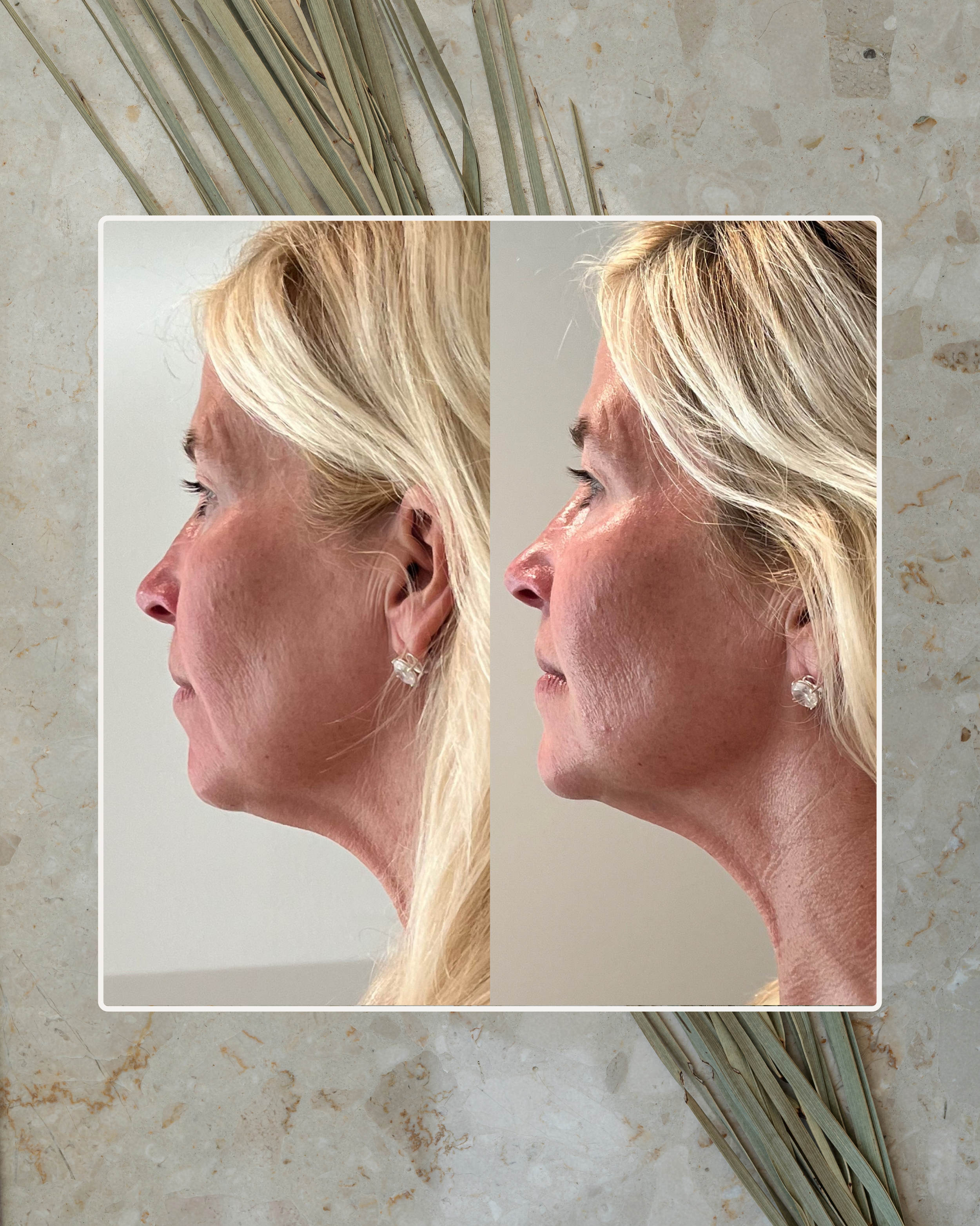 Jet Plasma Face and Neck