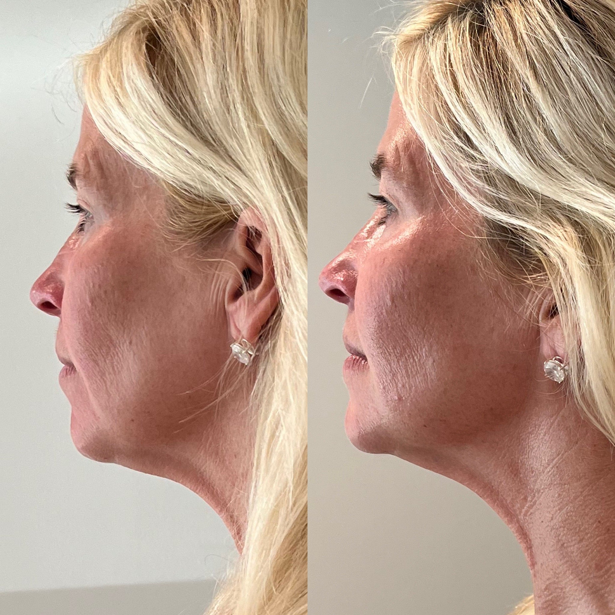 Jet Plasma Face and Neck