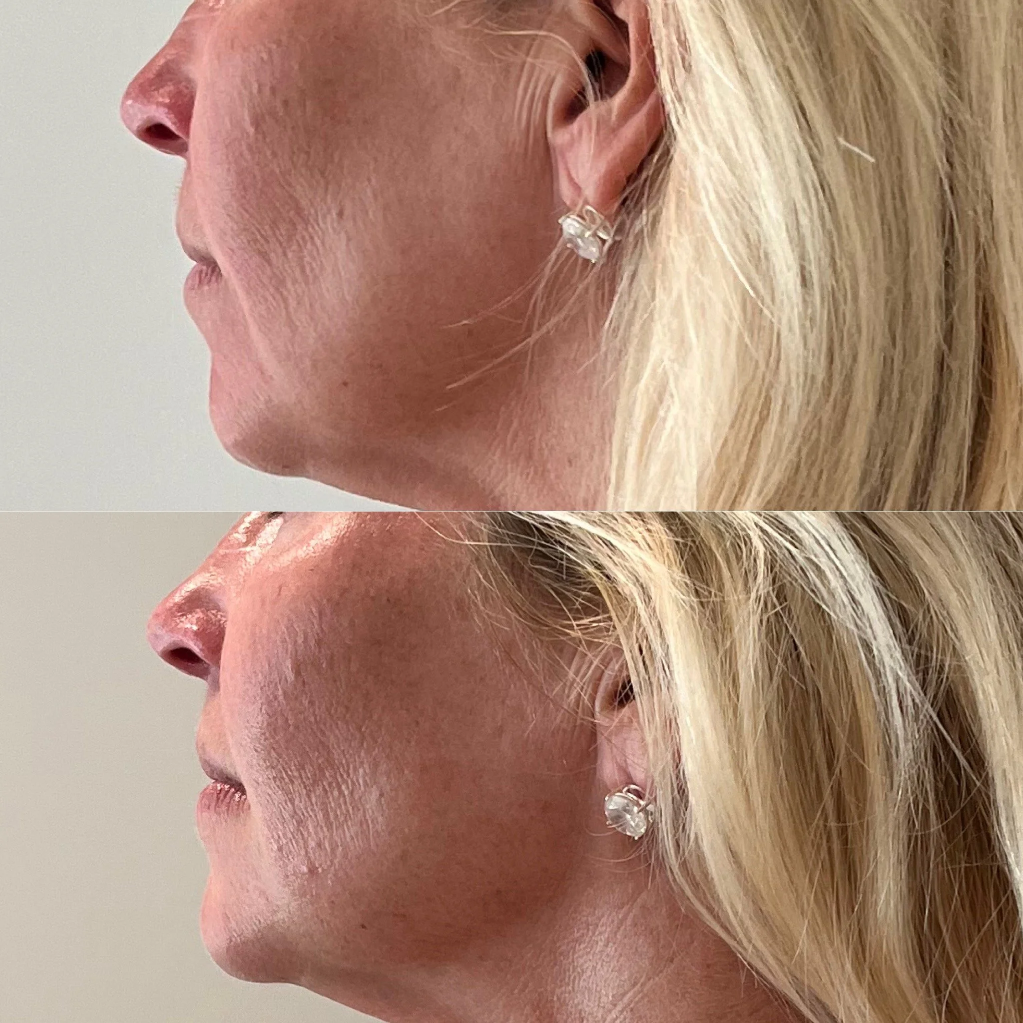 Jet Plasma Face and Neck