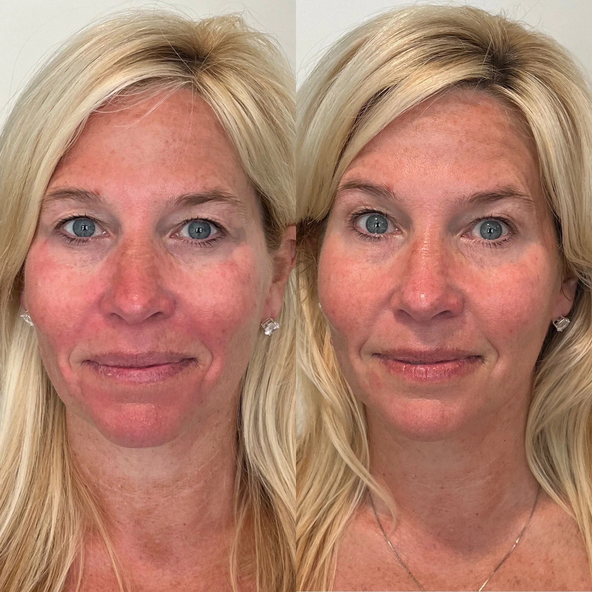 Jet Plasma Face and Neck