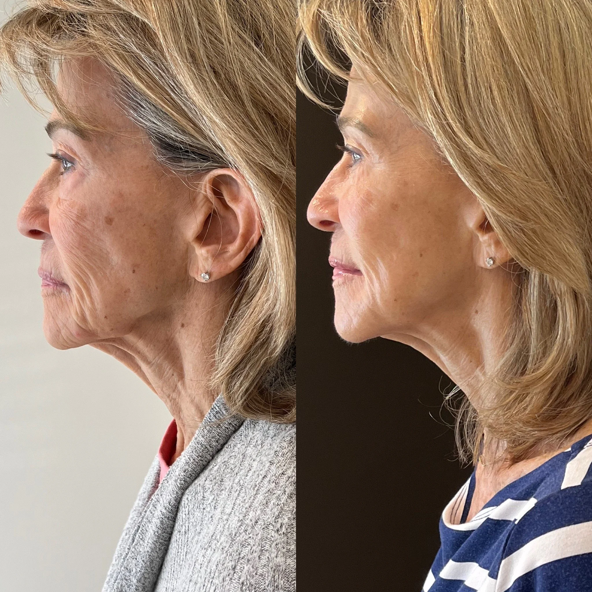 Jet Plasma Face and Neck