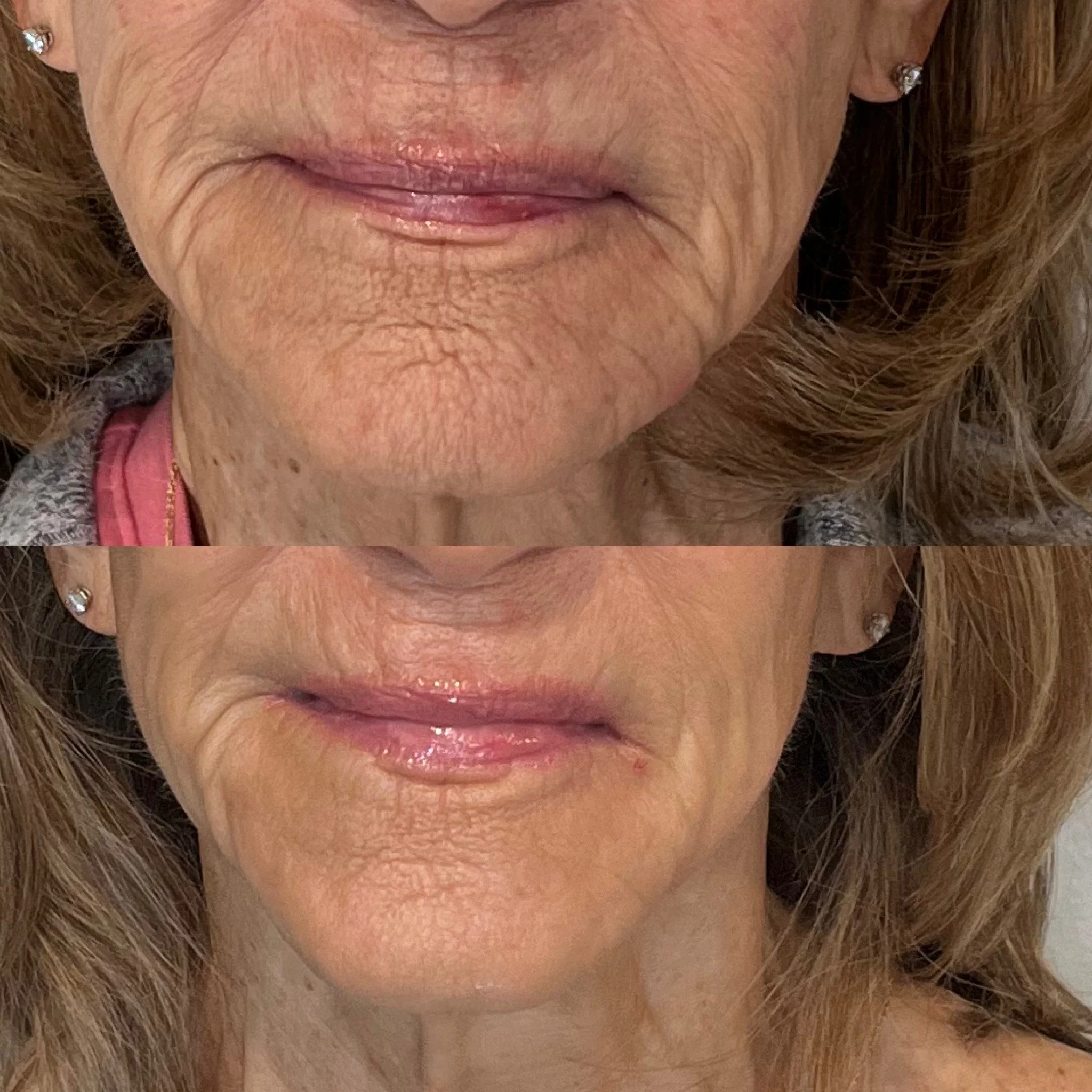 Jet Plasma Face and Neck
