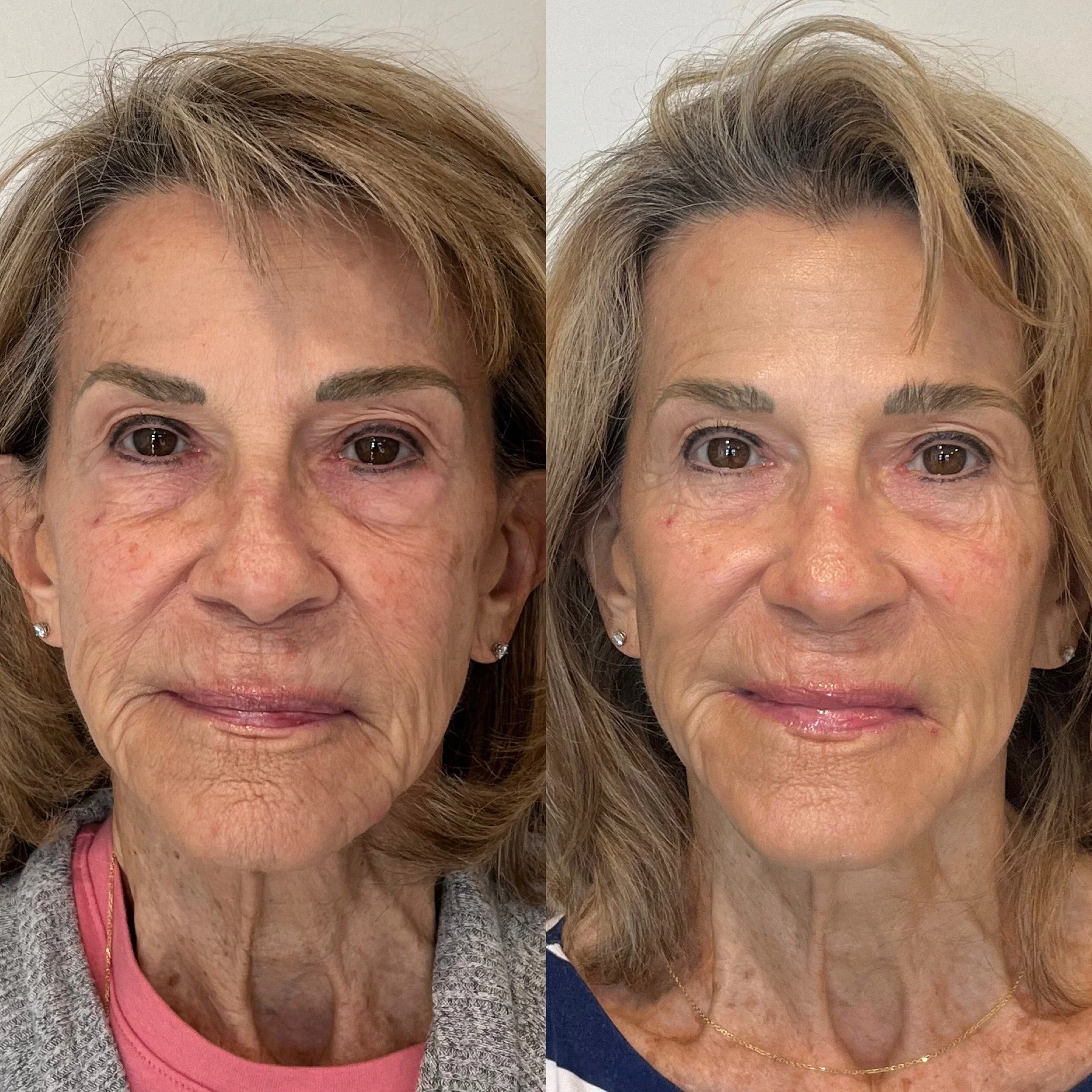 Jet Plasma Face and Neck