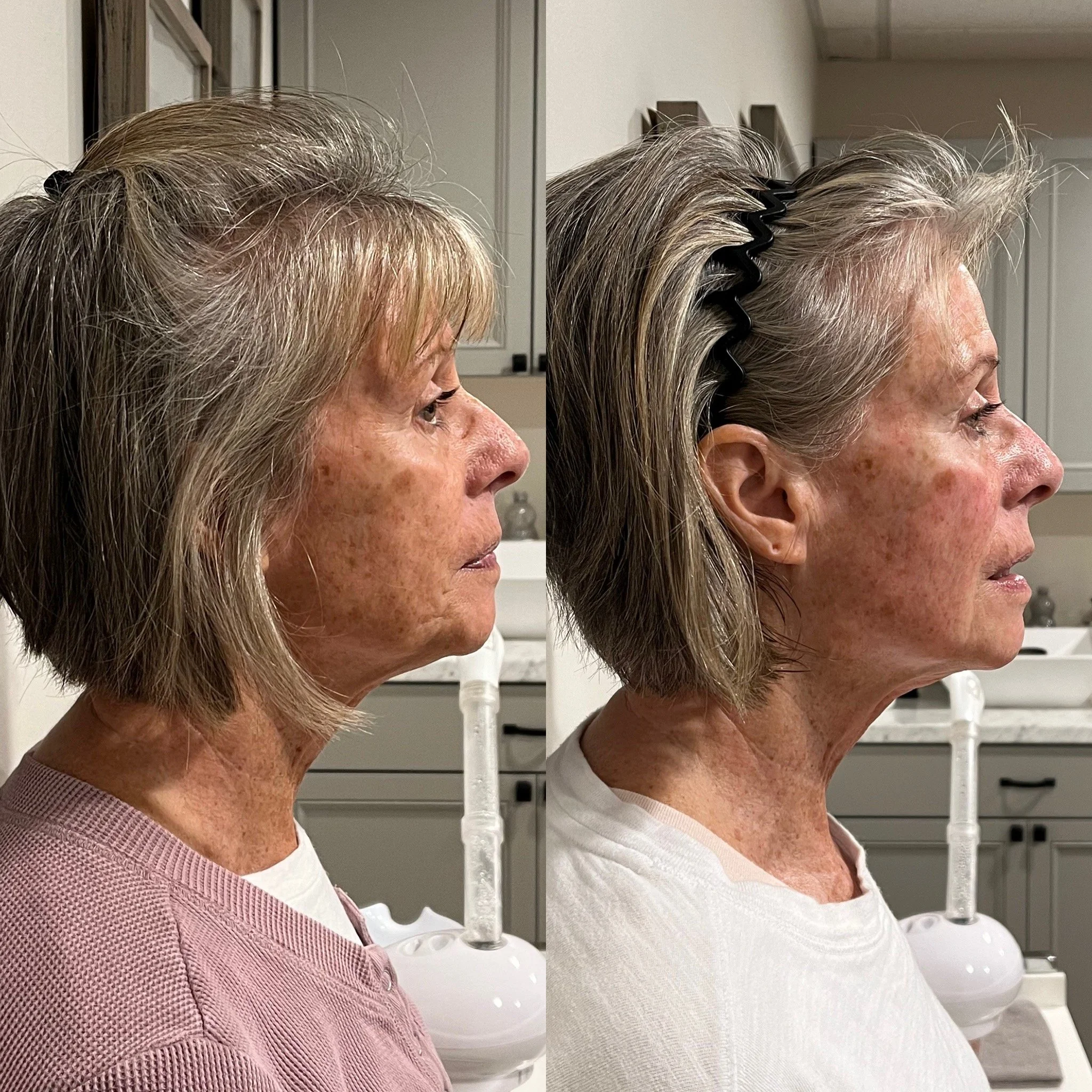 Jet Plasma Face and Neck