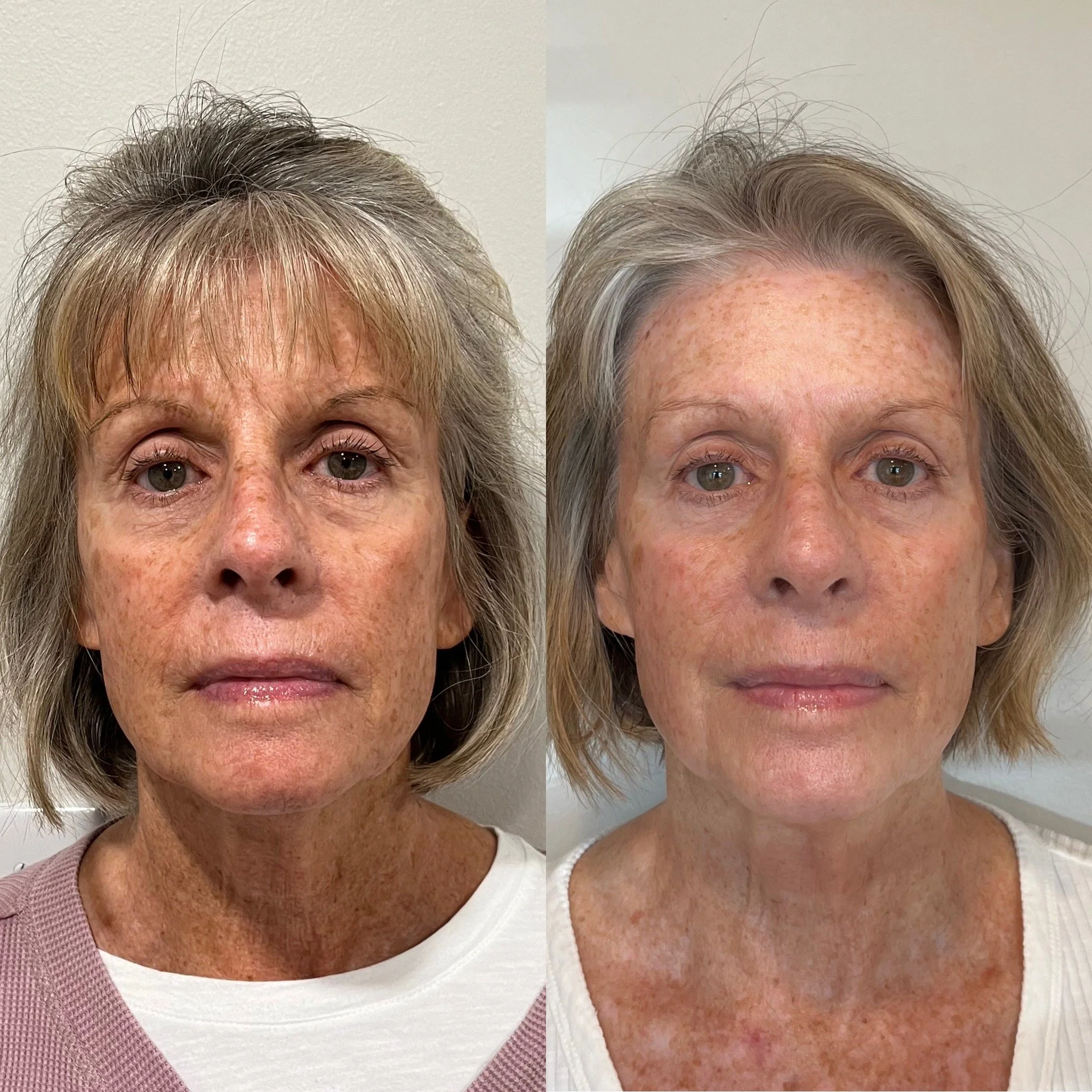 Jet Plasma Face and Neck
