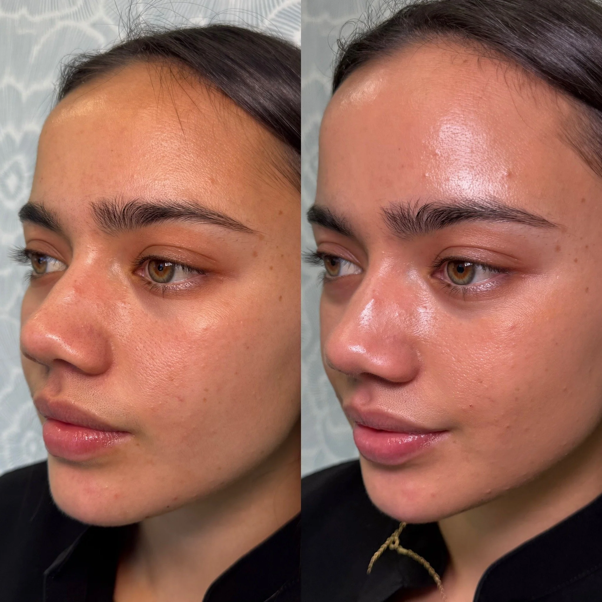 Close-up of a woman's face showing her forehead, eyebrows, and eyes with a before-and-after comparison of skincare or cosmetic treatment, highlighting improvements in skin smoothness and glow.