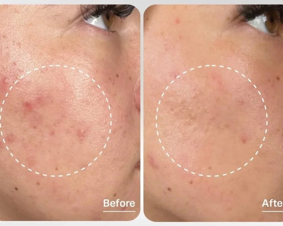 Comparison of skin condition showing reduction in acne scars or blemishes on a person's cheek, with 'Before' on the left and 'After' on the right.