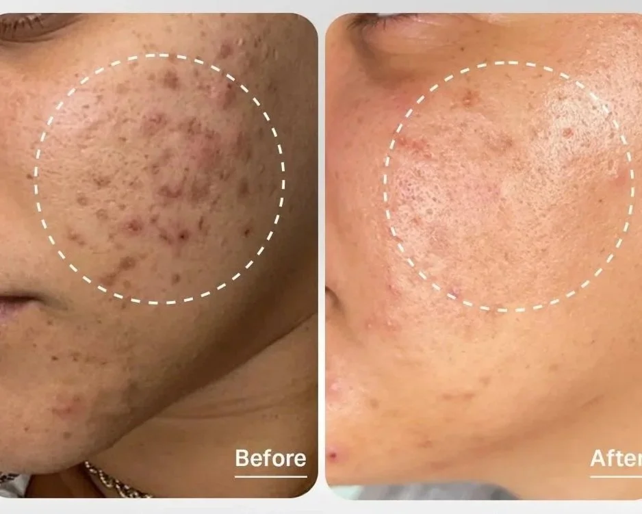 Comparison of a person's cheek showing acne scars and blemishes before and after treatment, with the "before" side having more visible scars and the "after" side showing clearer skin.