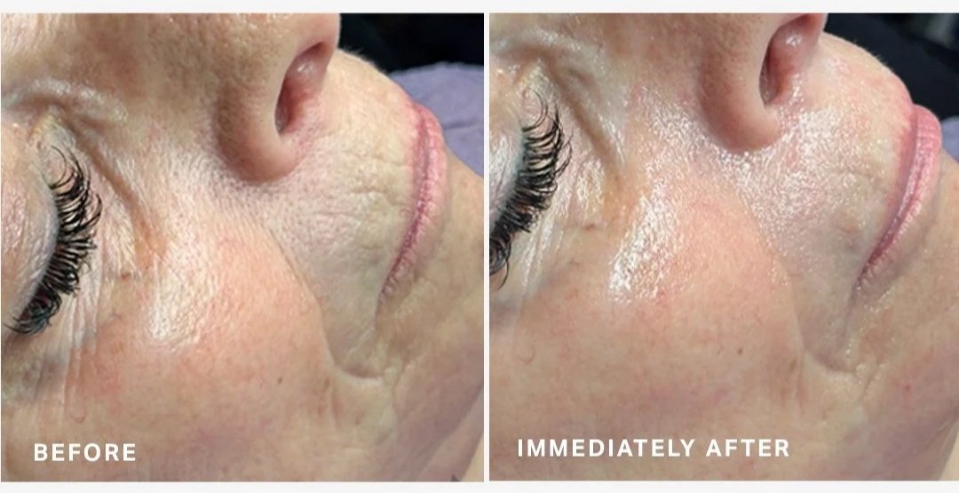 Close-up of a person's face showing a side view with wrinkles and skin texture; the left side labeled 'Before' and the right side labeled 'Immediately After,' indicating a skincare or cosmetic treatment result.