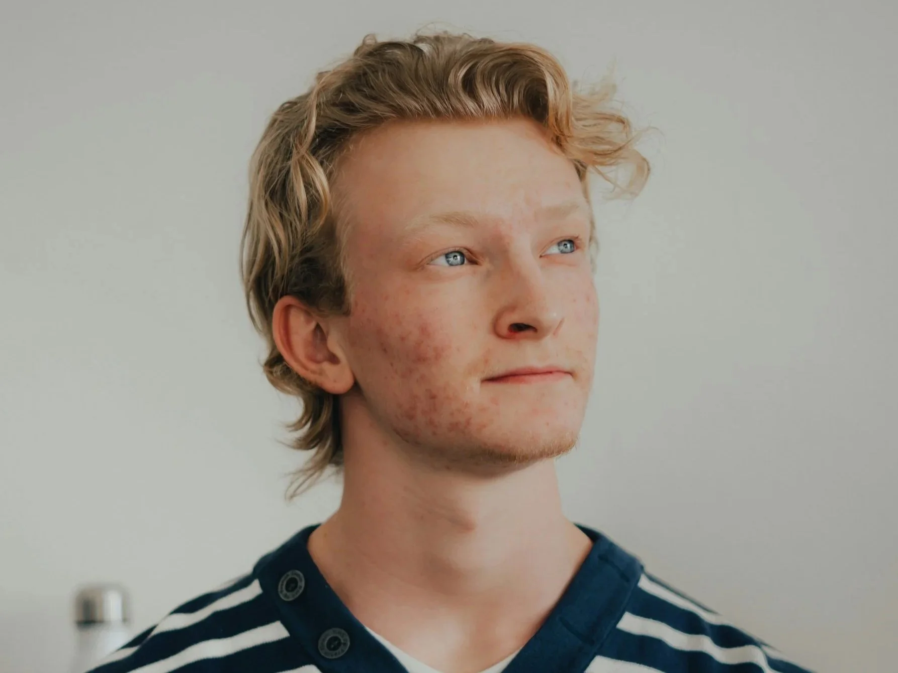 Close-up of a young man with red hair and blue eyes, wearing a navy and white striped shirt, looking to the right, against a plain light gray background. Acne , pitted skin, blemish correction, scars