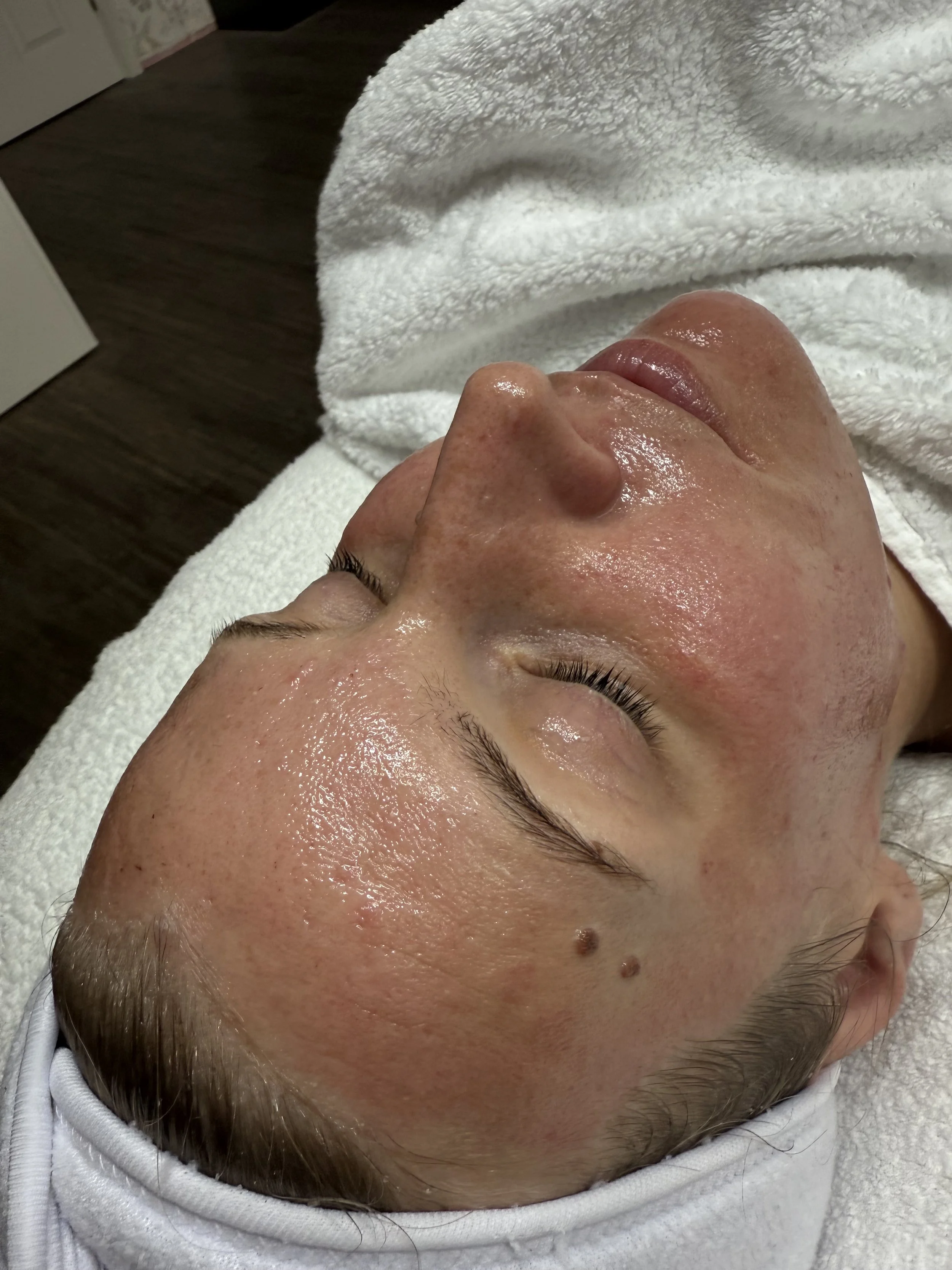 Close-up of a person's face with a shiny, moist appearance, lying on a white towel, showing skin with some freckles and moles.
