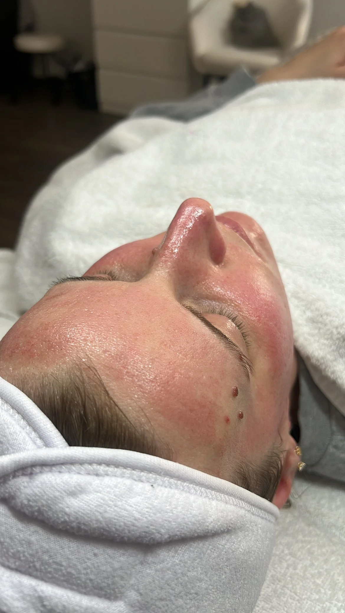 A person with closed eyes lying on a white towel in a spa or beauty treatment setting, with smooth, moisturized skin and some facial redness.