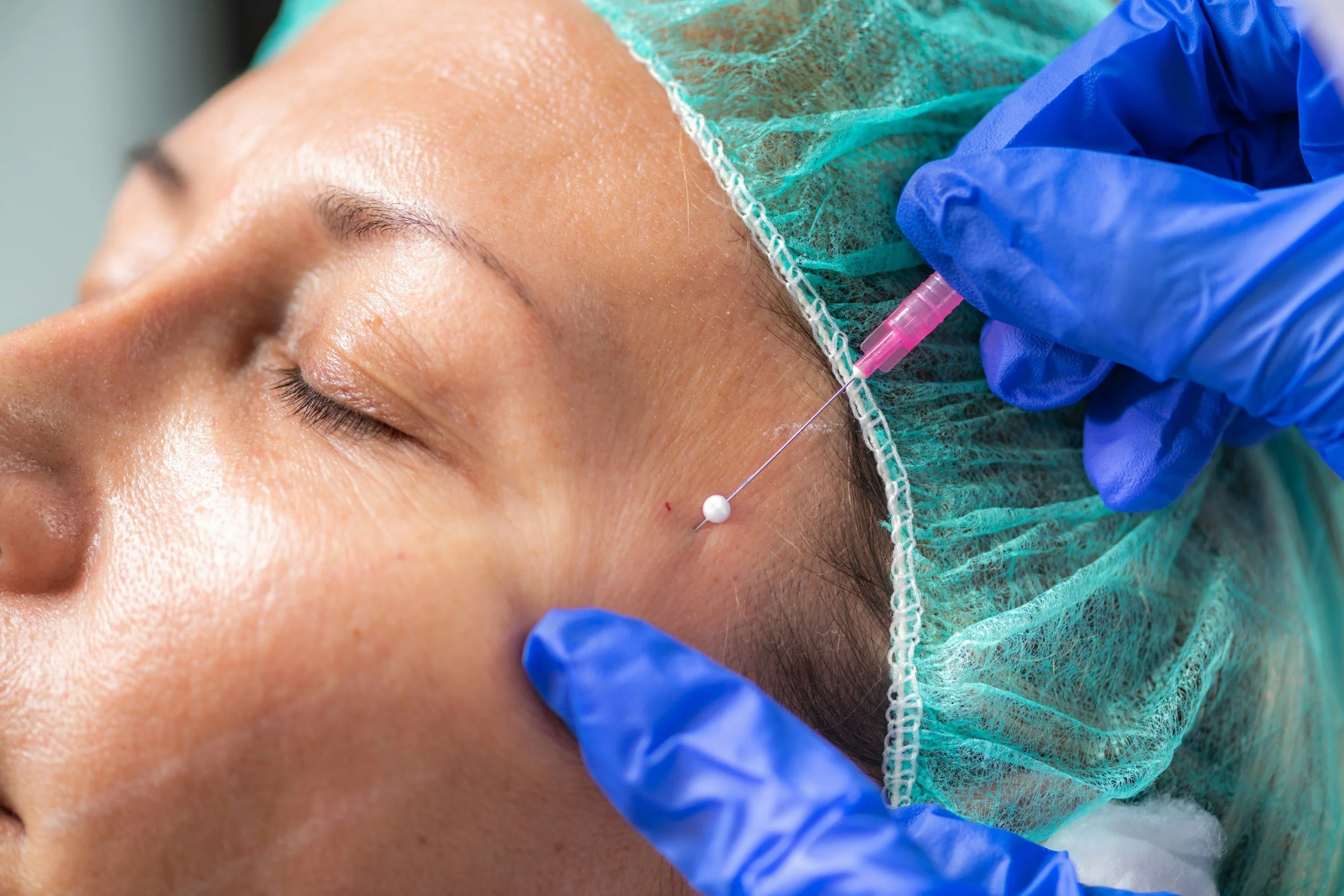 A person receiving a cosmetic injection near the eyebrow while lying down with eyes closed, wearing a green surgical cap, and having a blue-gloved hand administering the injection.