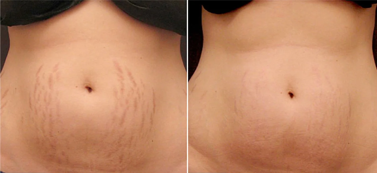 Procell Microchanneling Scar Revision