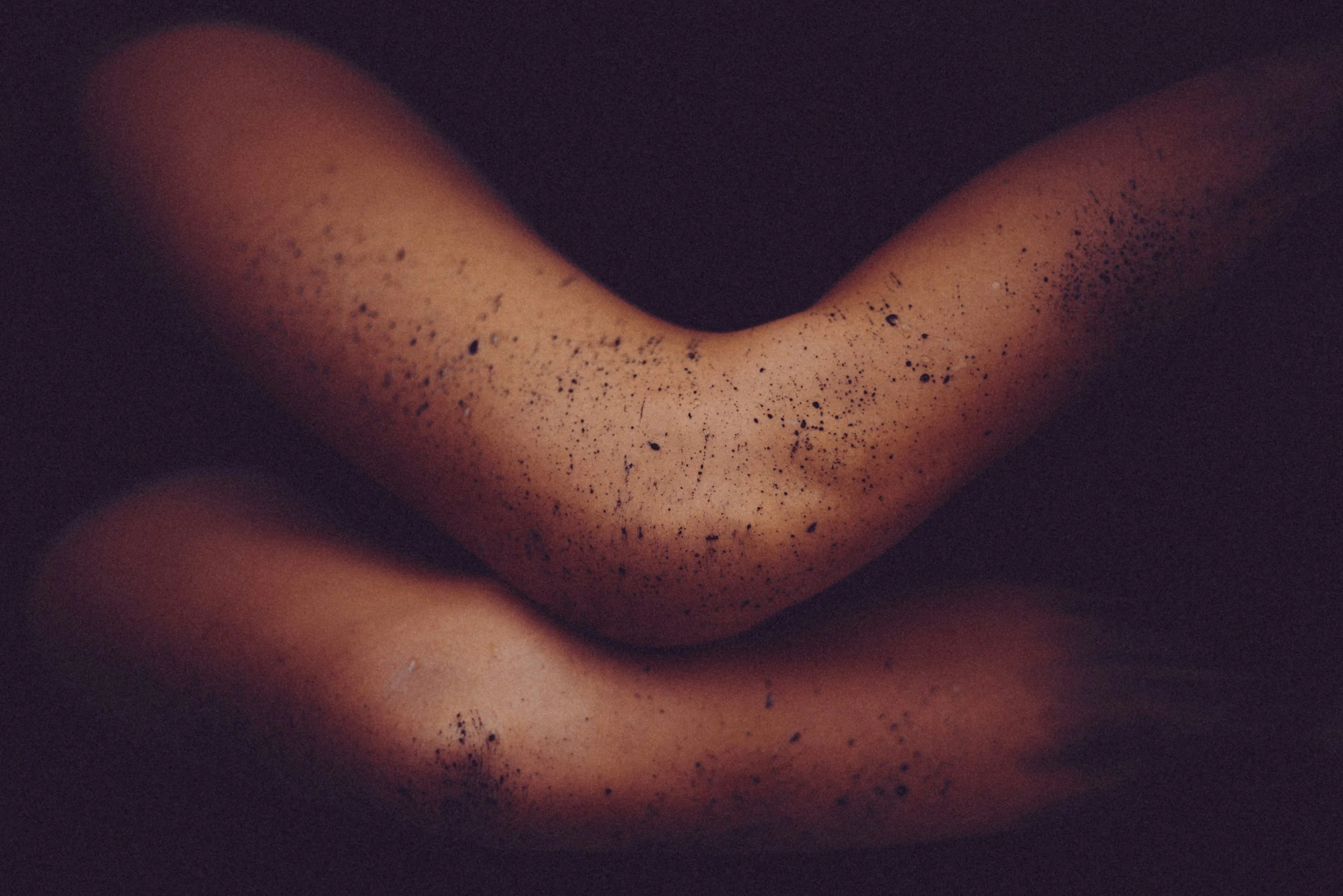 sugaring-calgary.jpg Body sugaring for clients with keratosis pilaris (KP), supporting smoother-looking skin with gentle hair removal at Wyld Sol in Calgary.