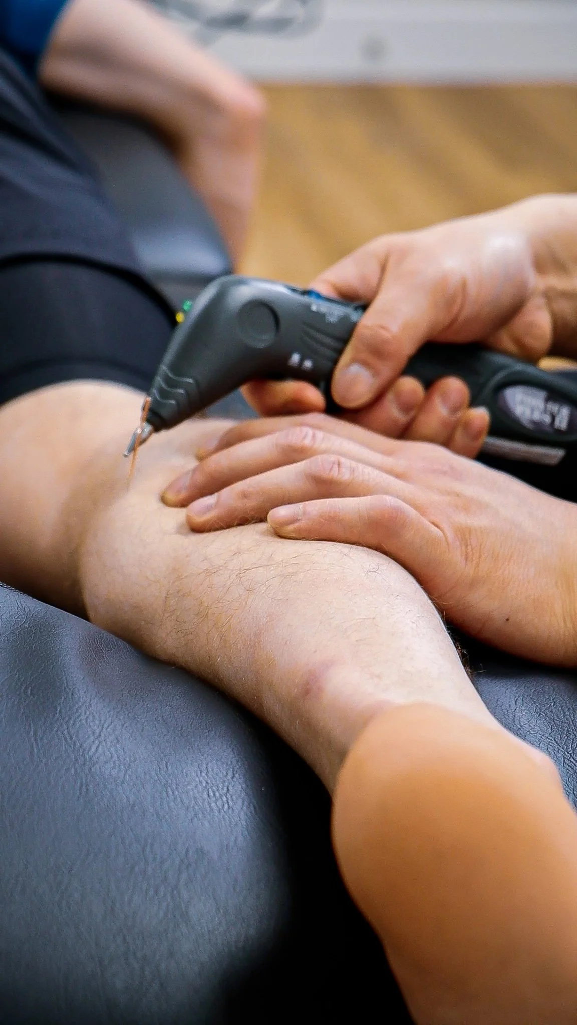 A person receiving acupuncture treatment, with a practitioner inserting thin needles into their bare leg.