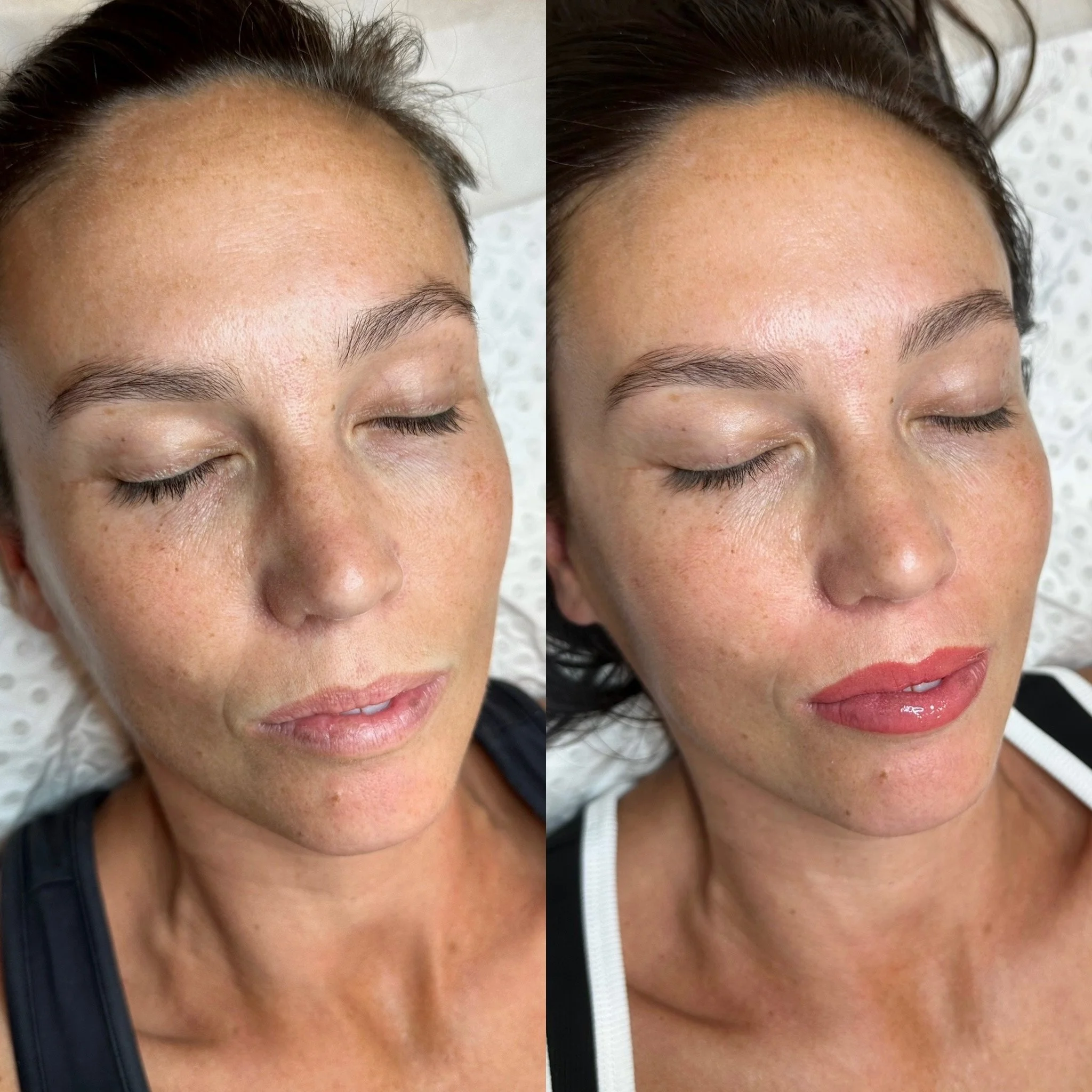 A close-up of a woman's face showing the transformation of her skin before and after a treatment. The left side displays visible freckles, dark spots, and uneven skin tone. The right side shows clearer, even-toned skin with reduced freckles and imper