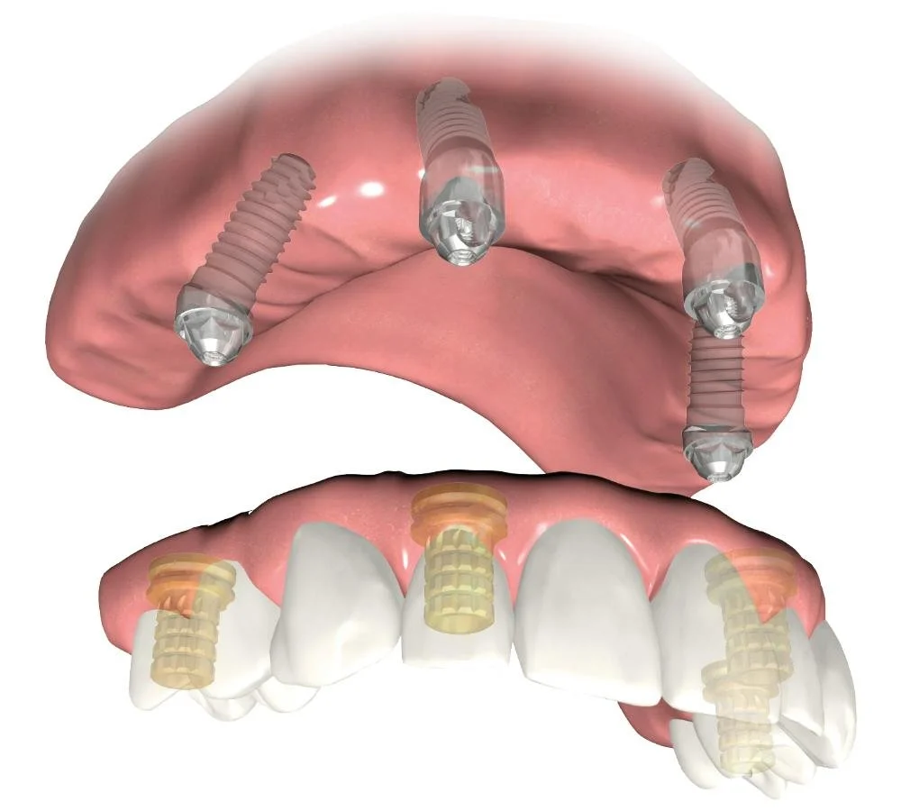 Darstellung eines dentalen Implantats mit vier Schrauben im Oberkiefer und entsprechenden Implantat-Kronen im Unterkiefer.