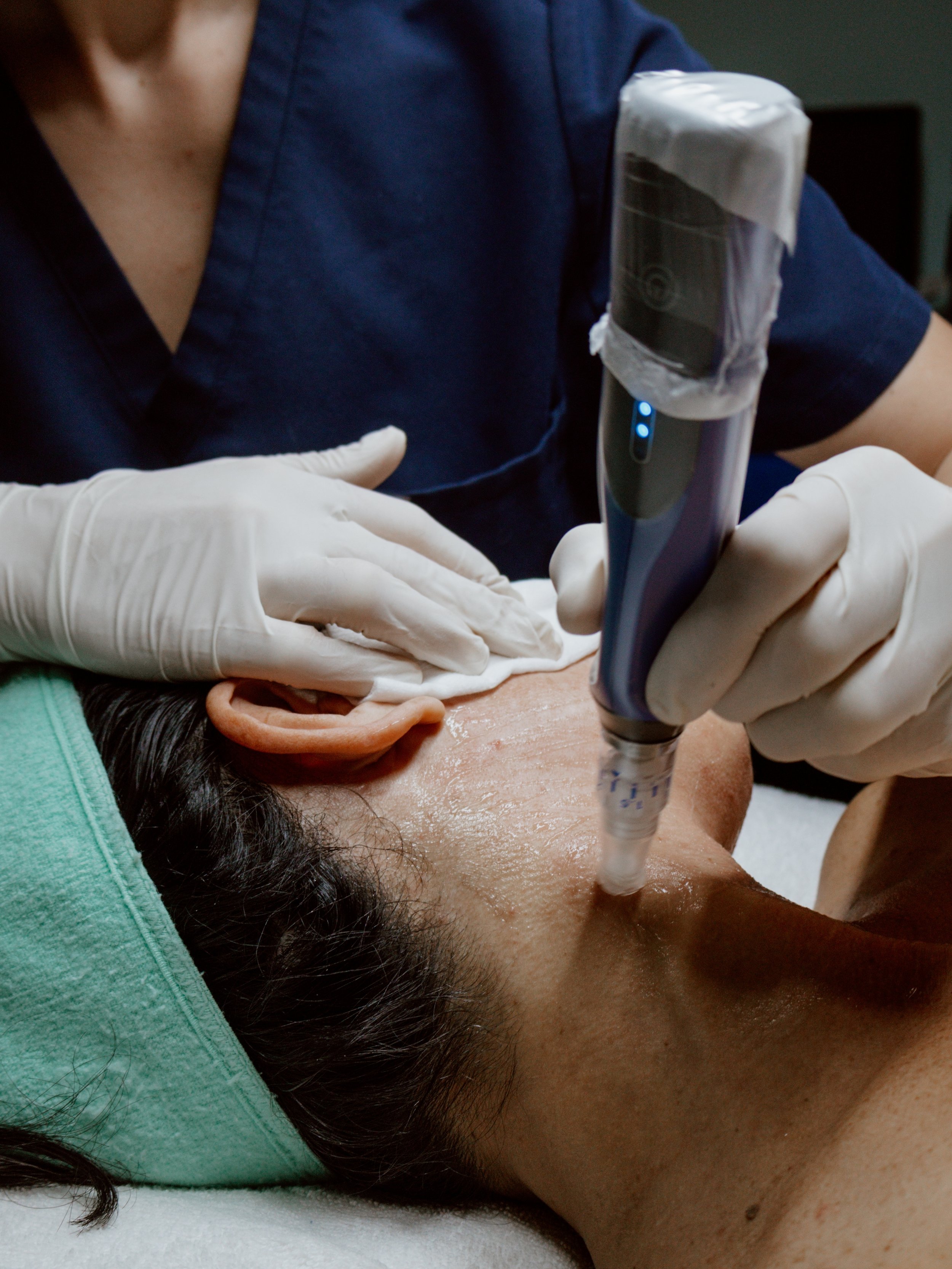 SkinPen® Microneedling: What to Expect Before, During, and After Treatment