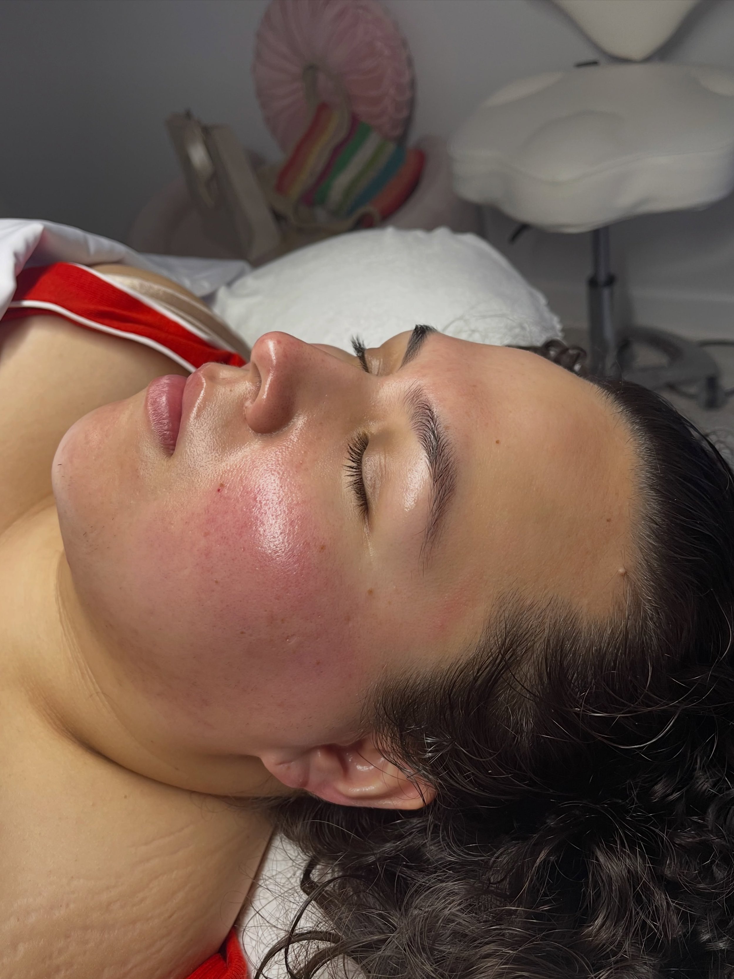 AFTER - BEFORE 

HydraFacial Deluxe customized to the skin&rsquo;s needs.

For this treatment, we performed a Deluxe HydraFacial, tailoring each step to the client&rsquo;s skin type and current concerns. The treatment included deep cleansing, exfolia
