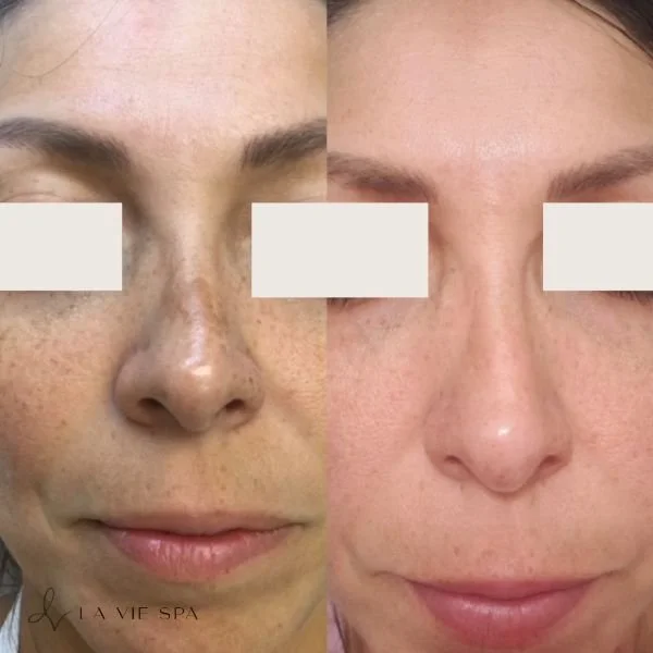 Side-by-side comparison of a woman's face showing before and after facial treatment, with improvements in skin tone and texture.