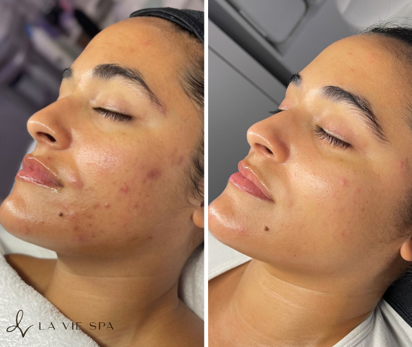 Side-by-side comparison of a woman before and after facial skin treatment, showing reduction in acne and improved skin smoothness.