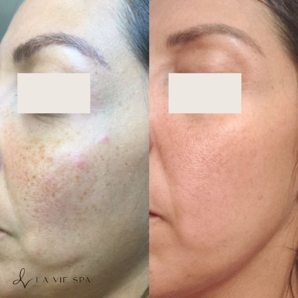 Side-by-side comparison of a person's cheek showing significant skin improvement, with before and after images of skin clarity and texture.