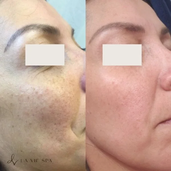 Side-by-side comparison of a woman's face before and after skincare treatment, showing reduced freckles and clearer skin on the right.
