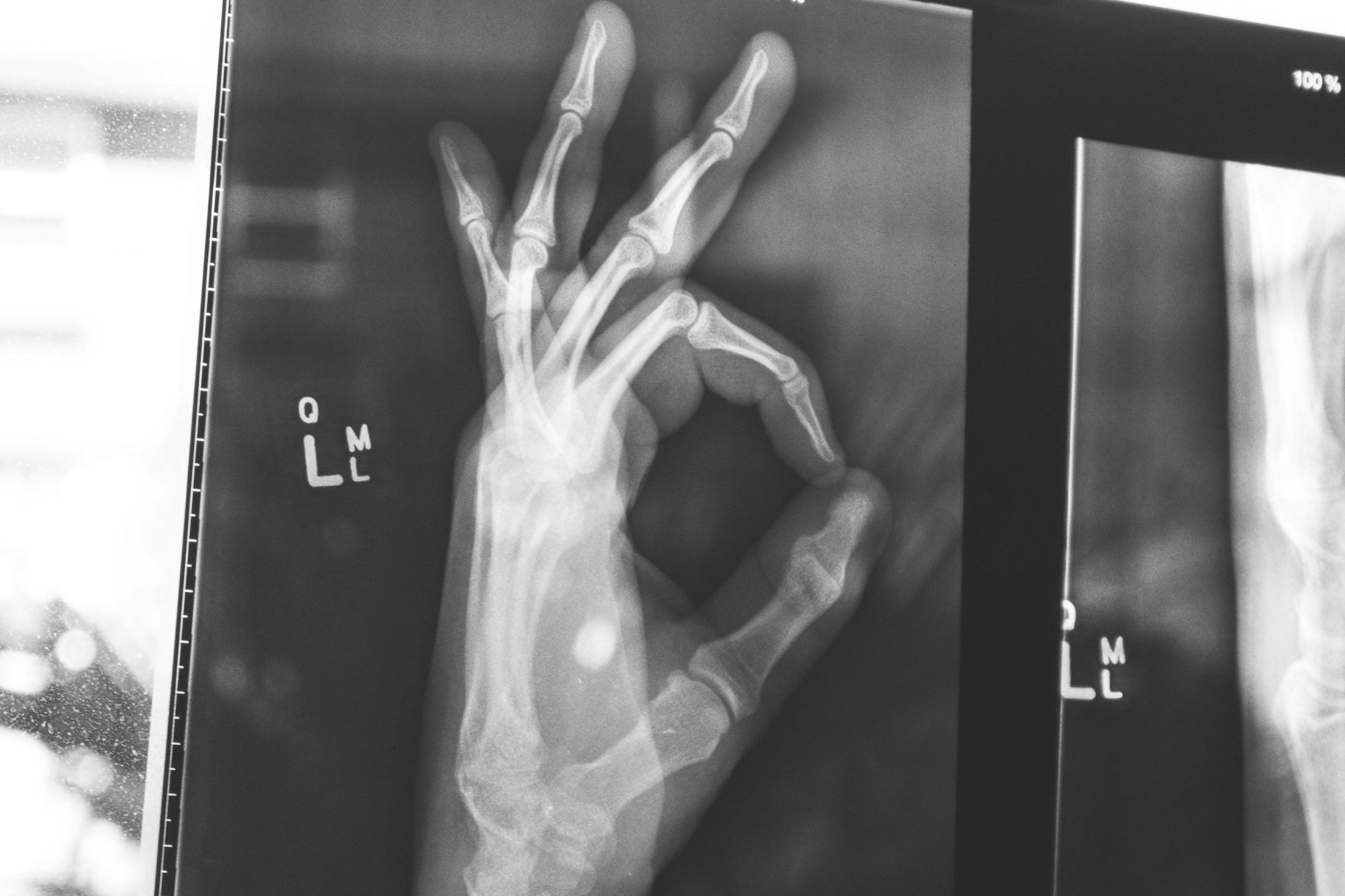 Your bone density predicts how long you will live