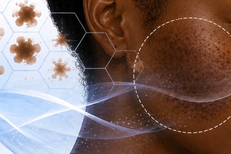 Hyper Focus: Mastering Hyperpigmentation in Skin of Color