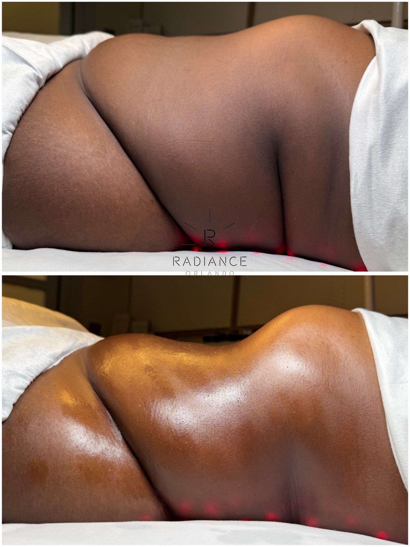 This is why we&rsquo;re booked weeks in advance 🫠

ONE session. Real client. Real results. 

👙 Extreme Stomach Sculpt $259

📍 7586 W. Sand Lake Rd. Suite 119

📱 (407) 721-5668 &mdash; Text to book

#orlandospa #bodycontouringorlando #bodysculptin