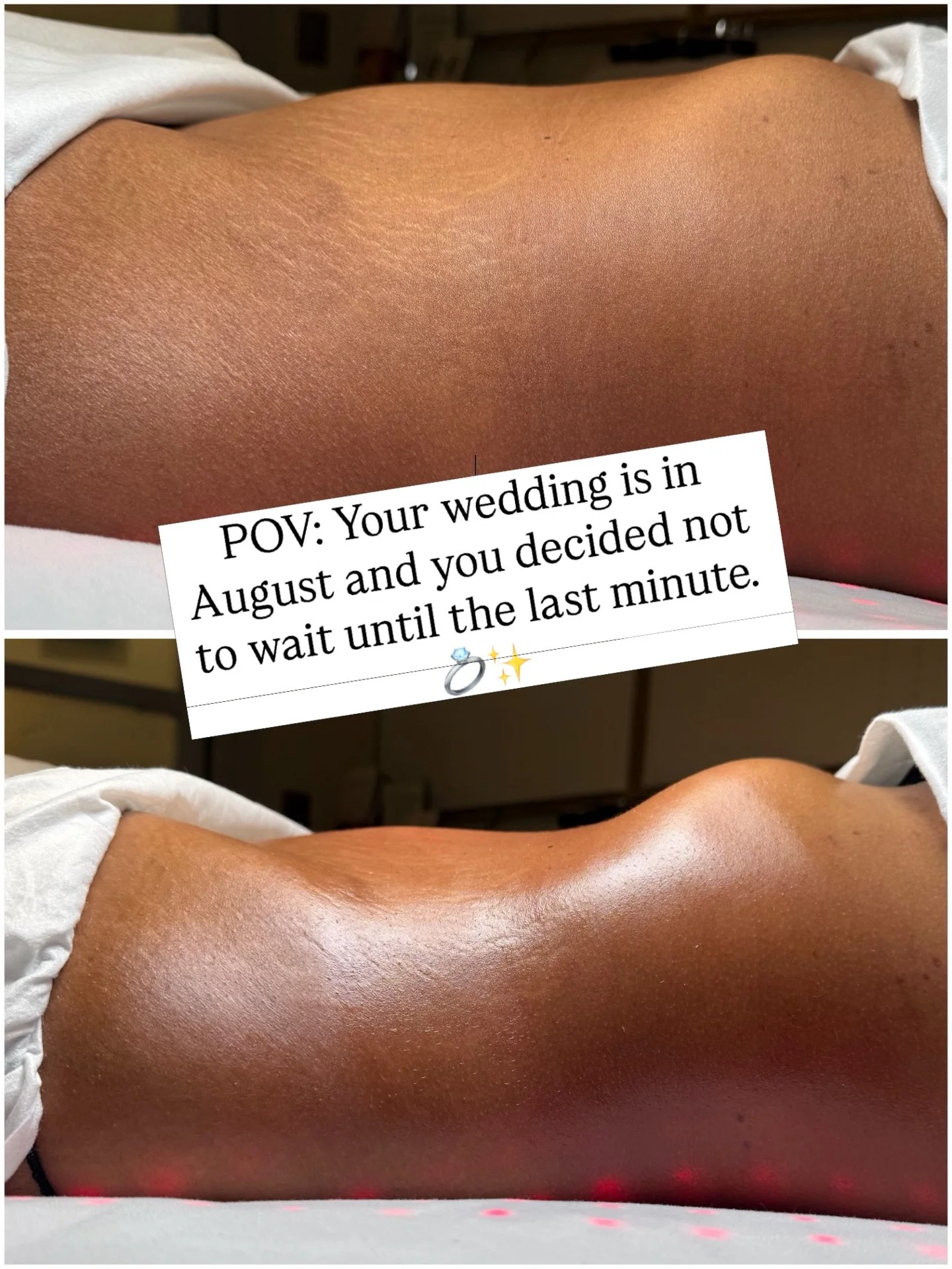One session down and already seeing beautiful results. We can&rsquo;t wait to see this gorgeous bride to be right before she says &lsquo;I do&rsquo; in the DR! 🌴😍

📍 7586 W. Sand Lake Rd. Suite 119

📱 (407) 721-5668 &mdash; Text to book

#orlando