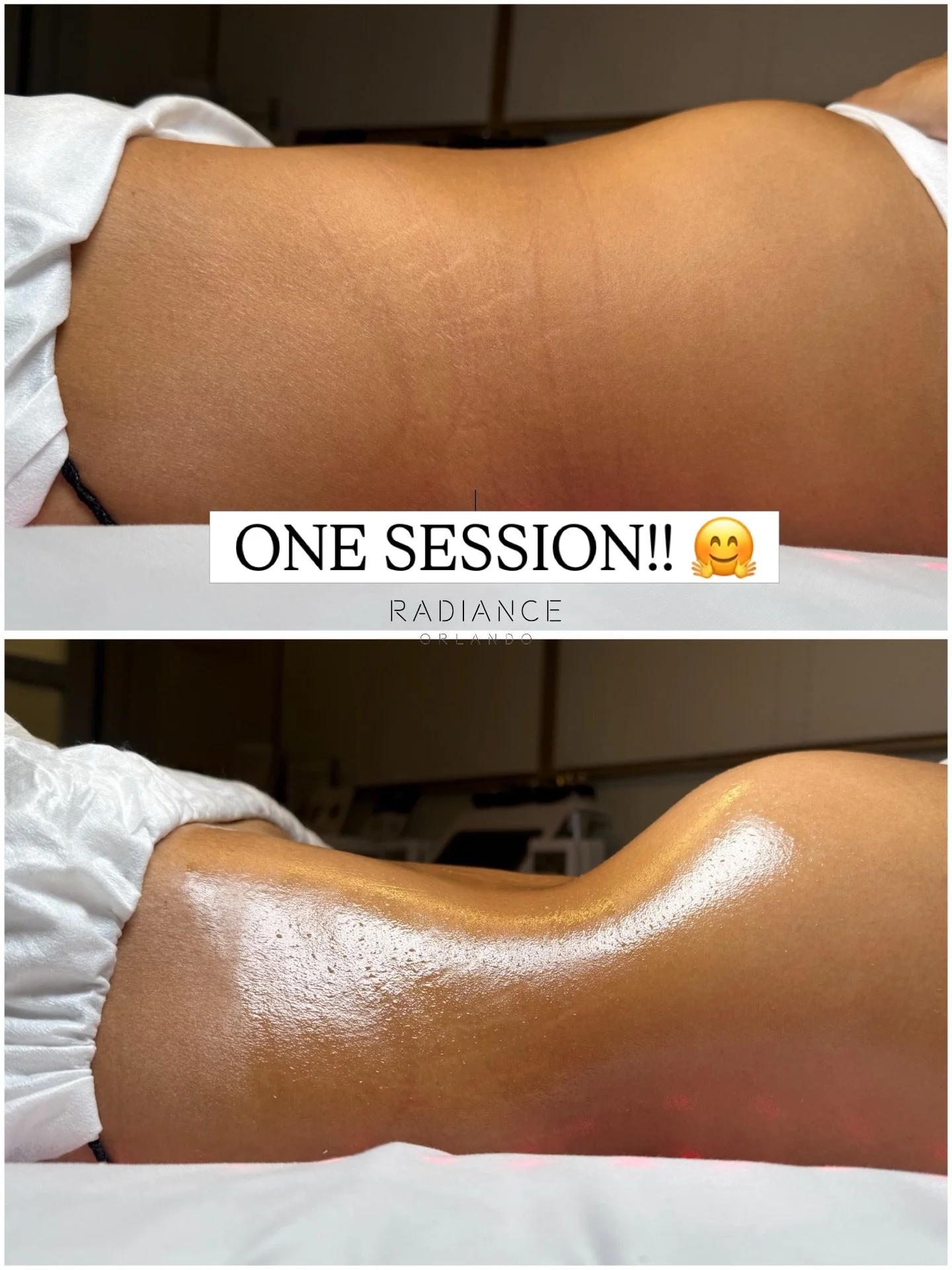 Wait&hellip; this is after just ONE session. 👀

No filters. No waist trainer. No tricks.

Just our signature Extreme Stomach Sculpt.

✨ Follow for real client results

📲 Text &lsquo;SCULPT&rsquo; to book (407) 721-5668

#orlandospa #orlandobodycont