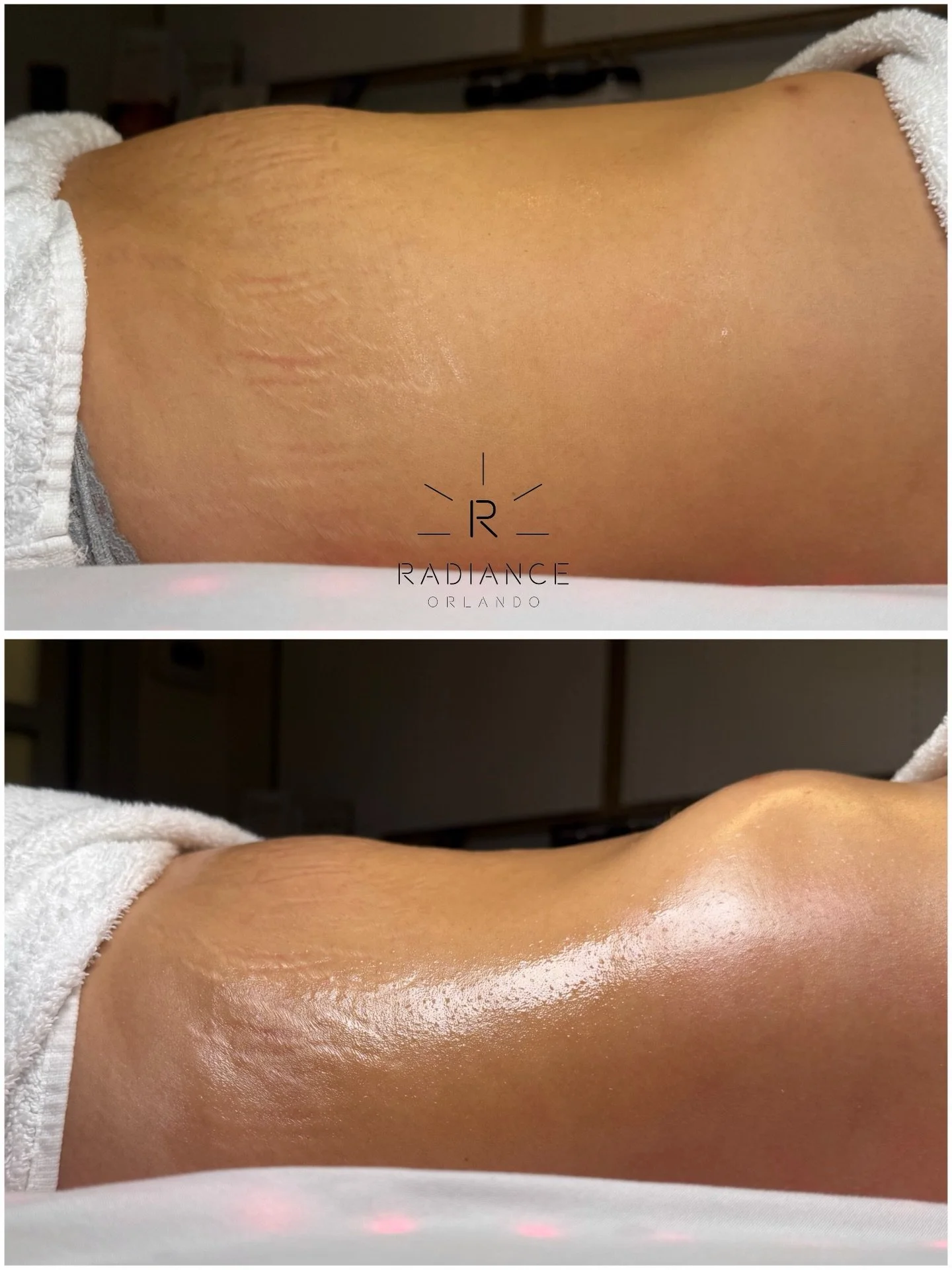 ⏰ She only had 20 minutes&hellip; so we made all 20 count. 🙌

This is exactly why I always say: you&rsquo;re not booking a massage&hellip; you&rsquo;re booking results.

Less time on the table. More visible change. ✨

Because at Radiance Orlando, we