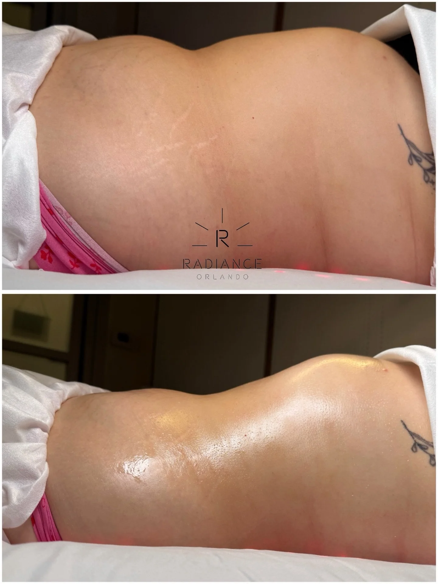 🚨 Don&rsquo;t skip the upgrade.

Same Client. Two single session results. The difference?

✨ Slide 1: Extreme Stomach Sculpt + Laser Lipo Pads  ✨ Slide 2: Extreme Stomach Sculpt alone

Laser Lipo Pads are designed to prep the treatment area before w