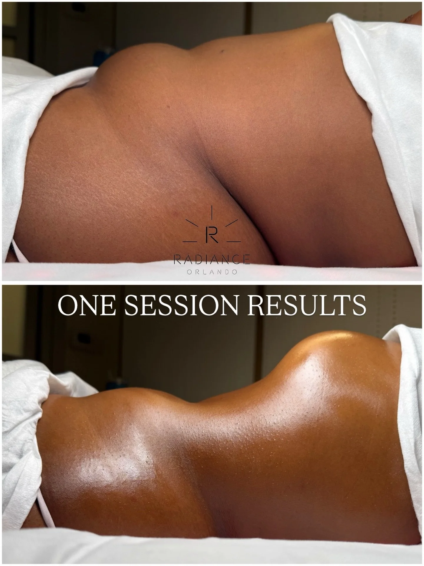 Ohhh baby&hellip; now THIS is how you start a weekend. ✨ 

One session, one transformation and one very happy client. Who&rsquo;s next? 🤍

Book your Extreme Stomach Sculpt for only $259 ⬇️

📲 www.RadianceOrlando.com

📍 7586 W. Sand Lake Rd. Suite 