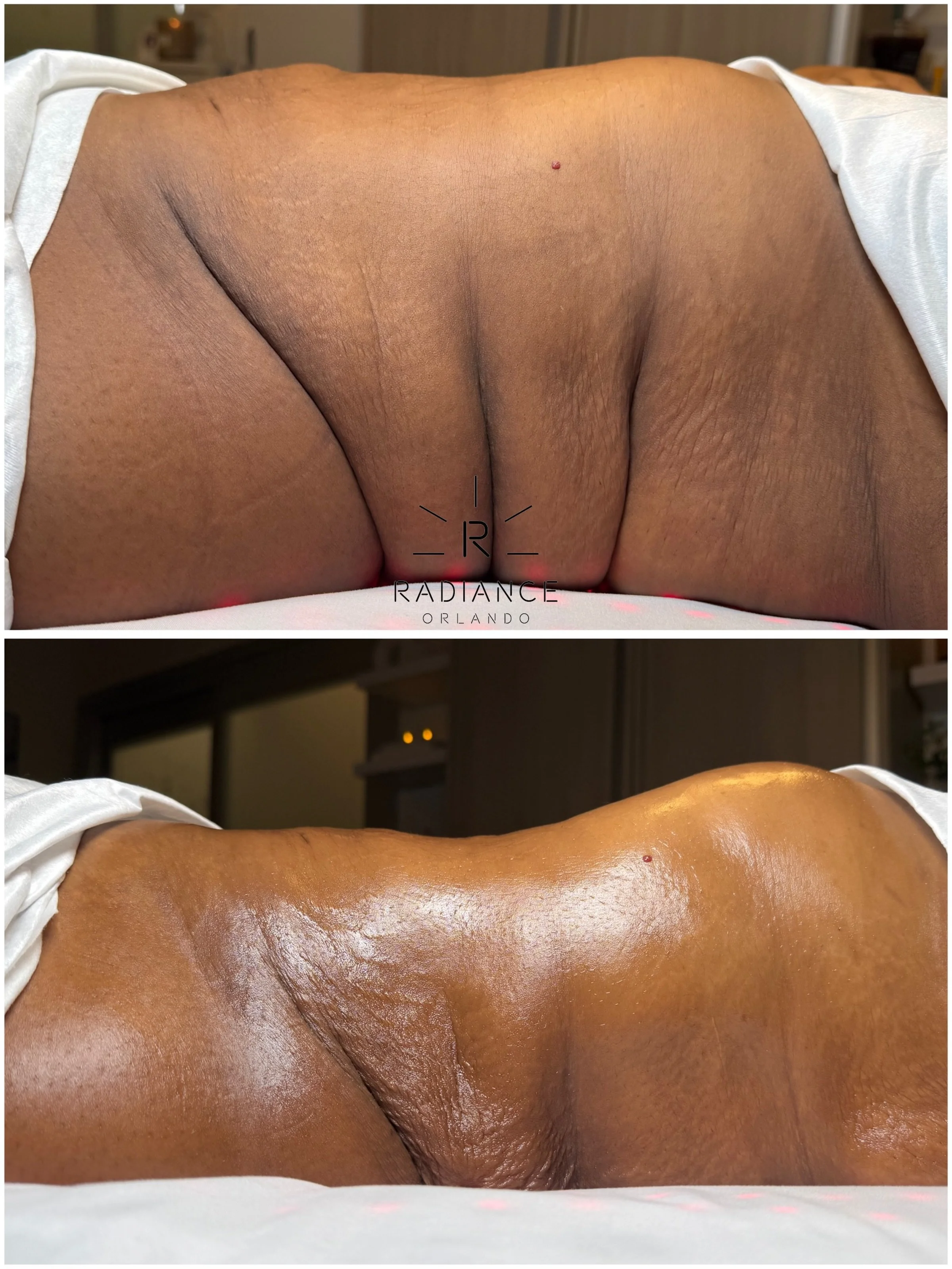 LIPO 360 WASN&rsquo;T THE END OF HER JOURNEY. 👀

She came to us a few months after Lipo 360 wanting to refine what surgery left behind, more definition through the waist, smoother looking sides and back and a tighter, more sculpted appearance.

This