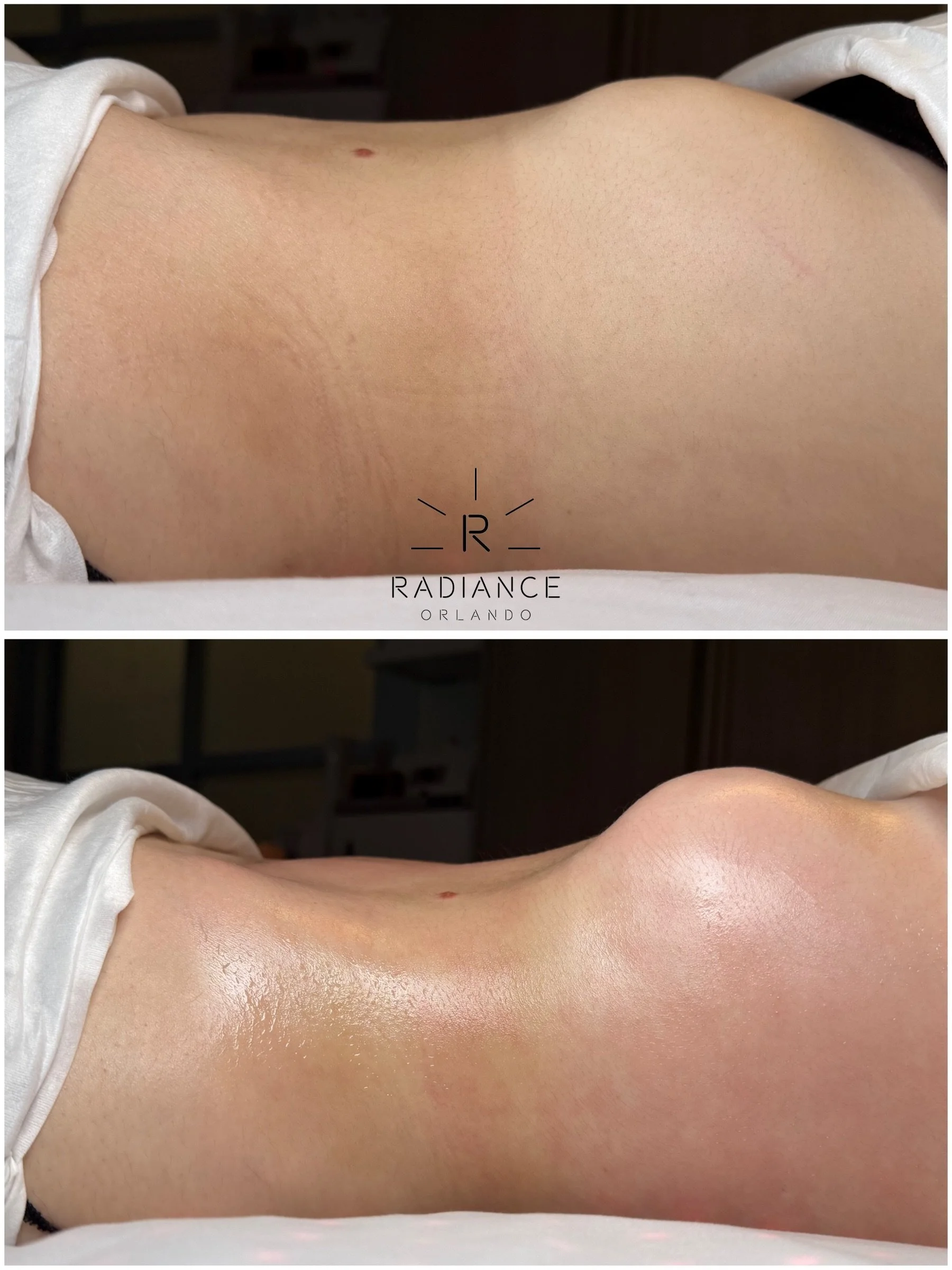 WAIT&hellip; WHERE DID THOSE RIBS COME FROM?! 👀🔥

This is why our Extreme Stomach Sculpt continues to be our most requested treatment.

ONE SESSION.
No surgery. No downtime. No filters.

Just strategic sculpting designed to reduce the appearance of