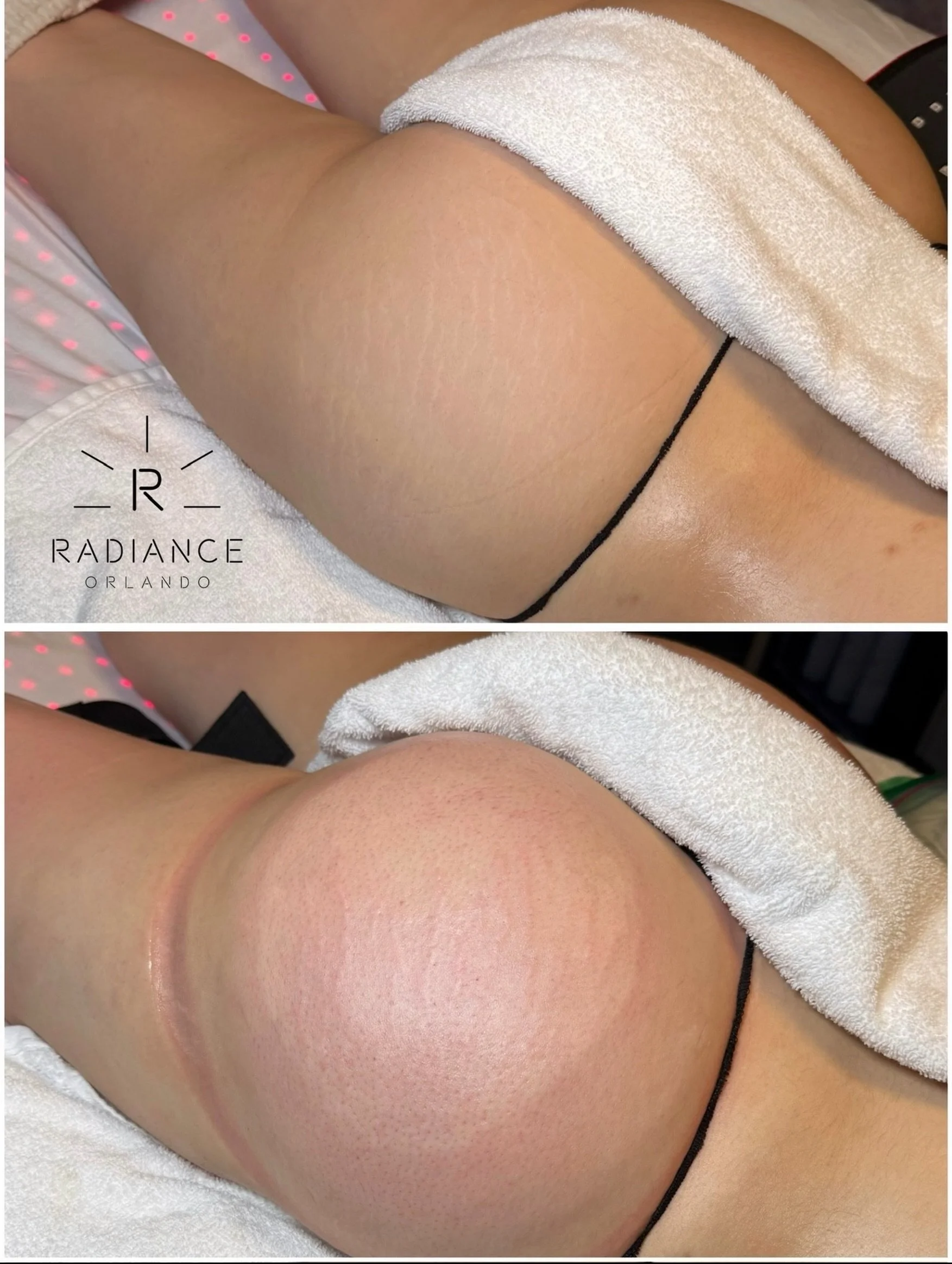 We don&rsquo;t make the rules&hellip; we just raise the standards. 🍑⬆️

One session. No surgery. Just a little strategic lift. 😉

Vacuum Booty Lift | $189

📍 Dr. Phillips

Book at RadianceOrlando.com

#orlandobbl #orlandospa #orlandobodycontouring