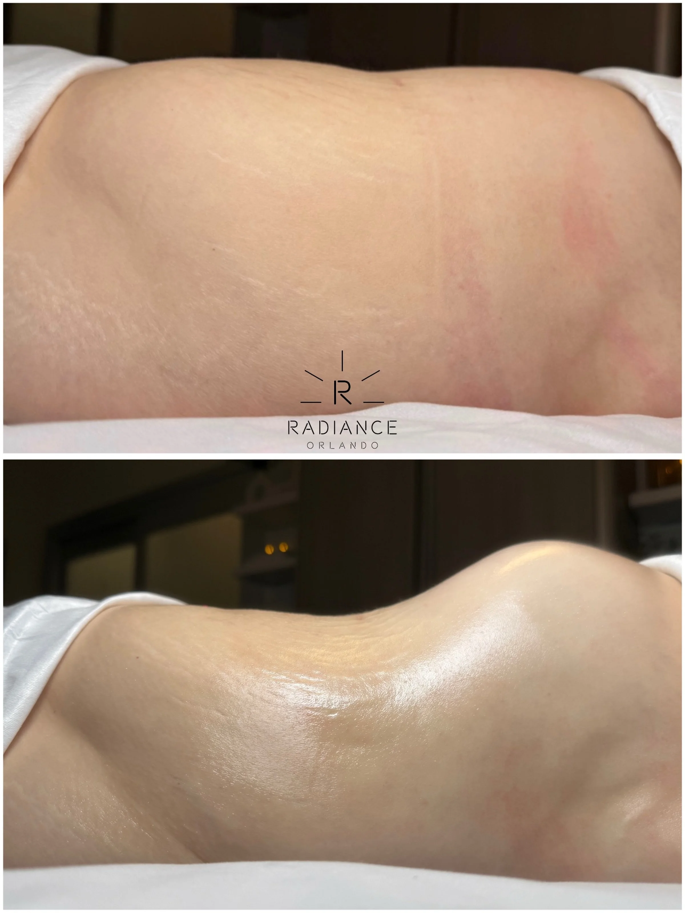 Now THAT&rsquo;S a way to start the weekend. 👏🏼🔥

This beauty came in for her Extreme Stomach Sculpt + Fat Cavitation and left with a whole new silhouette.

Real client. Real results. ✨

📍 Dr. Phillips | Orlando

Ready to see what your body can d