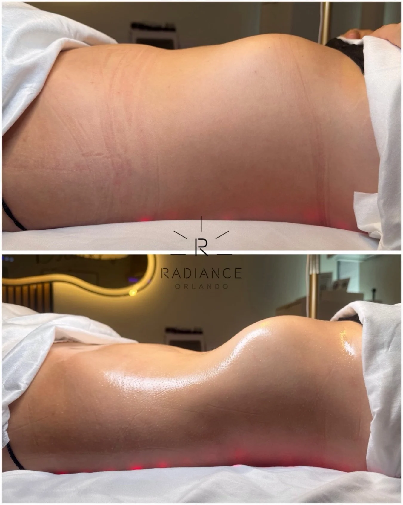 Another ONE-SESSION transformation by Hannah. 🔥

The holidays are closer than you think&hellip; and our calendar fills FAST. 👀

If you want your Extreme Stomach Sculpt before the holiday parties, photos, travel and events begin, now is the time to 