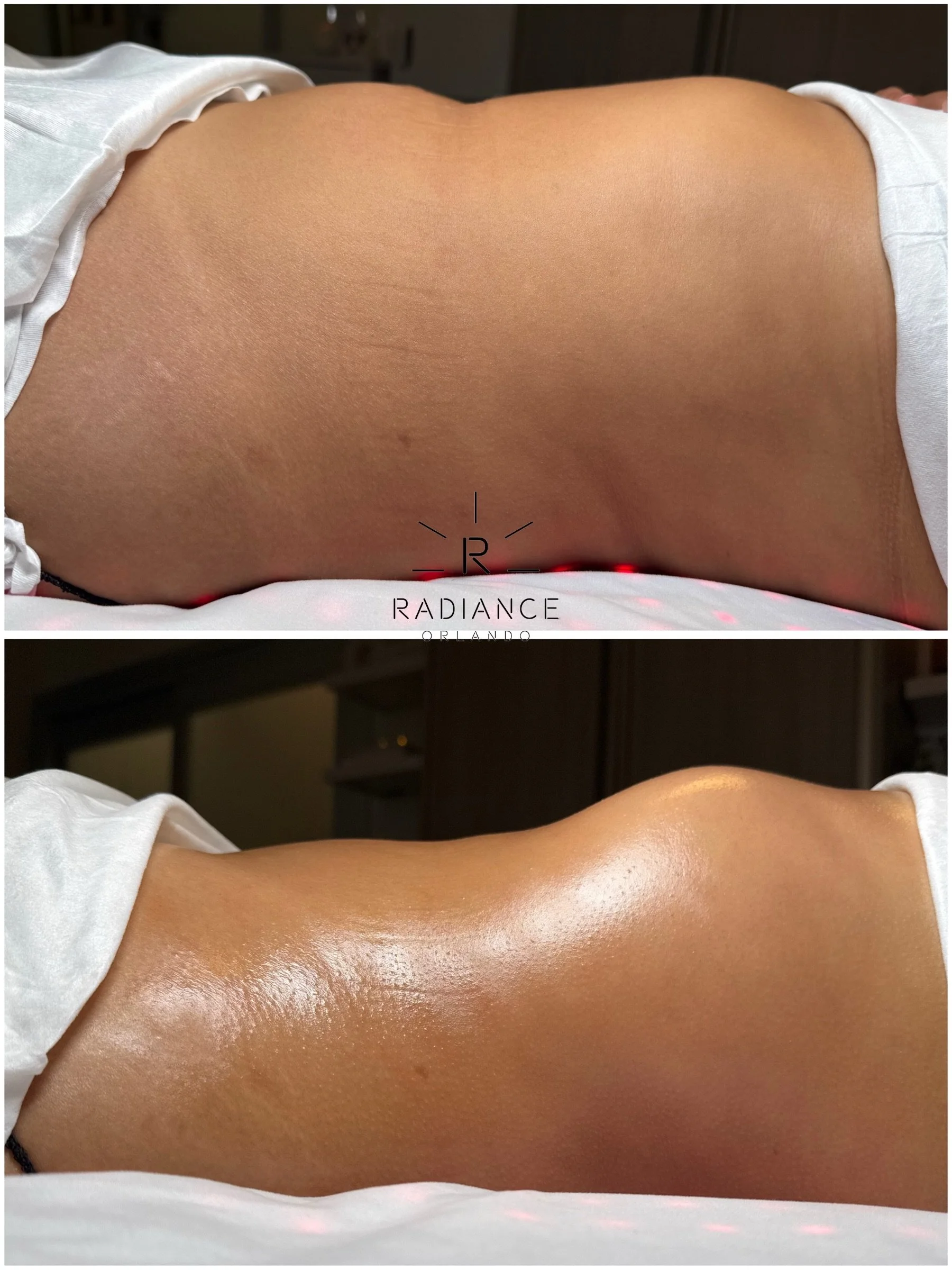 ONE session. TWO transformations. 🔥

Extreme Stomach Sculpt + Booty Lift and this beauty is officially weekend ready. 👙🍑

One appointment. Visible results. That&rsquo;s the Radiance difference.

📍Orlando | Book your transformation at RadianceOrla