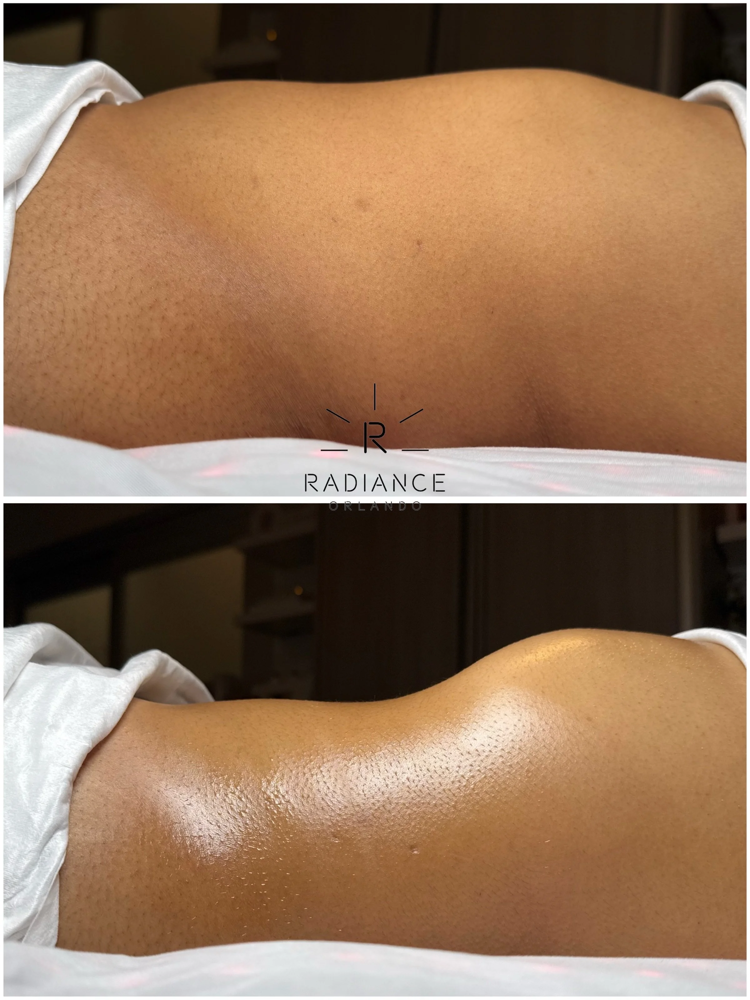 Just another transformation Tuesday at Radiance Orlando. ✨

She&rsquo;s a package client, but this before + after is from ONE session.

Because sometimes you don&rsquo;t have to wait until the end of the series to start seeing the difference.

One ap