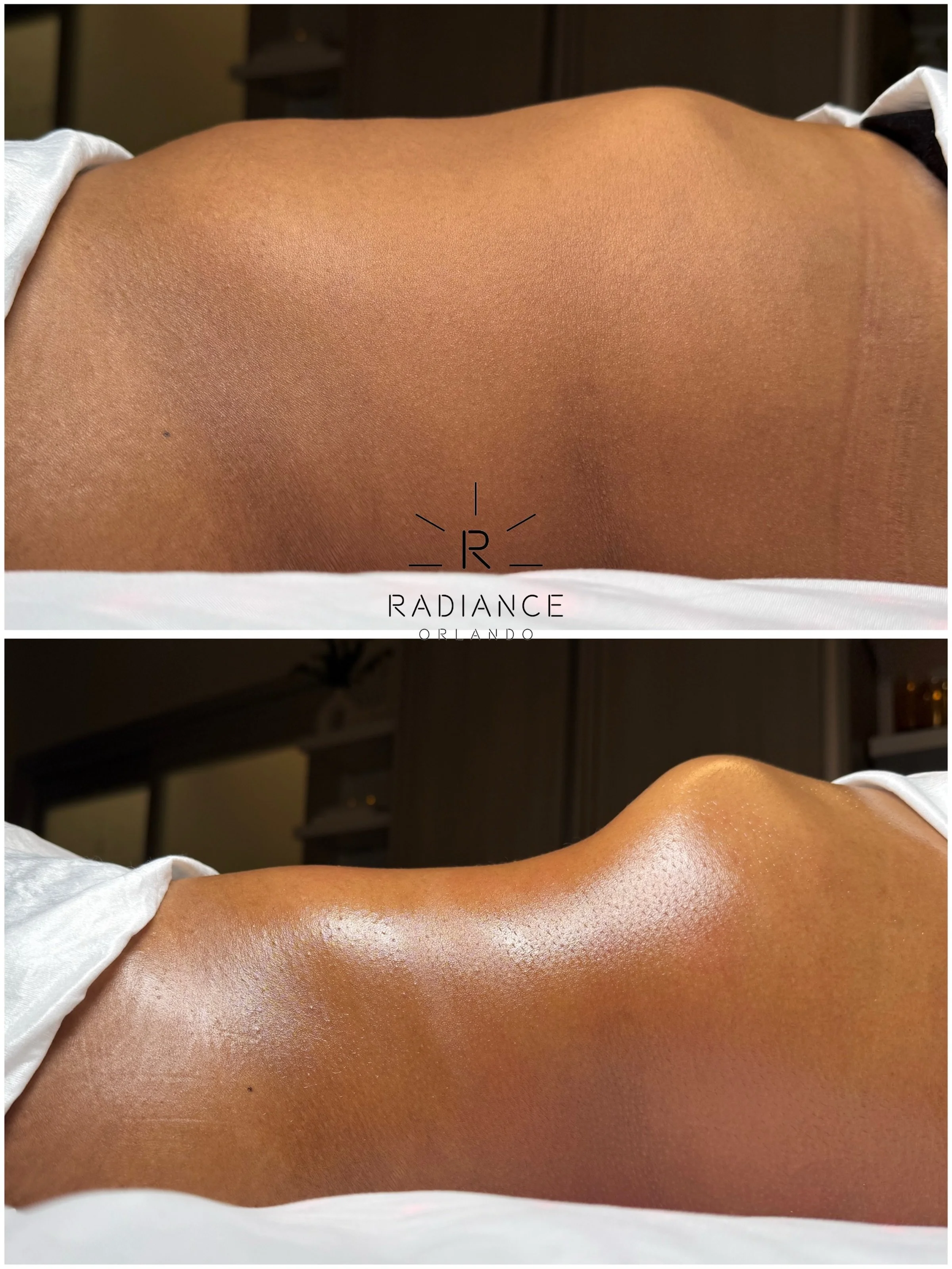 ONE SESSION. ONE TRANSFORMATION. ✨

Another Extreme Stomach Sculpt result performed by our Founder, Jeanette Macall 

No surgery. No downtime. Just our signature approach to cosmetic body contouring.

🏆 Orlando&rsquo;s destination for one-session re