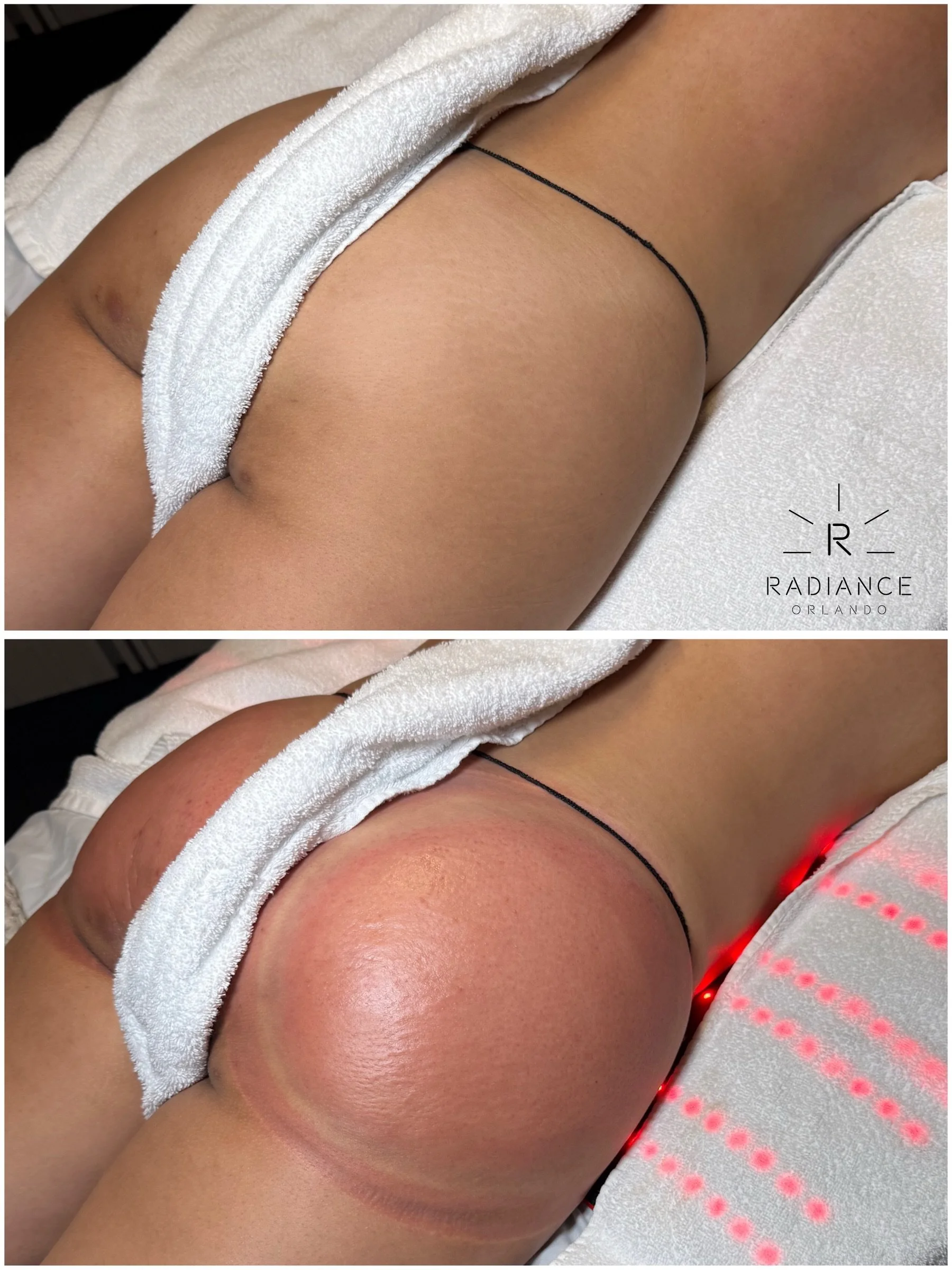 Consider this your Thursday booty call. 📞🍑

ONE SESSION Vacuum Booty Lift

Book Here ➜ RadianceOrlando.com

📍 Dr. Phillips, Orlando

#bootylift #orlandospa #orlandobodycontouring #orlandobodysculpting #bodycontouring