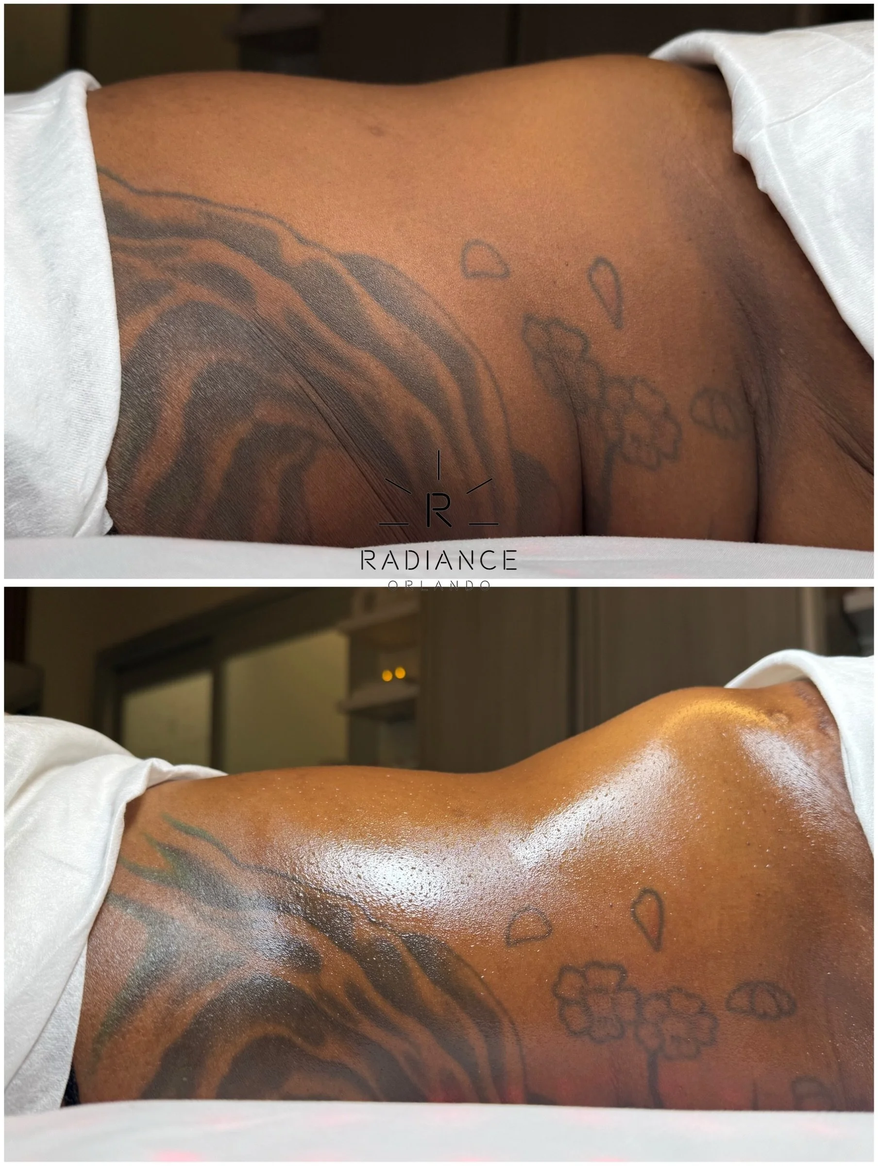 ONE session down&hellip; FOUR more to go! 👀🔥

And THIS is her starting point after just ONE Extreme Stomach Sculpt + Fat Cavitation session! 😍

She&rsquo;s already committed to four more sessions and we cannot WAIT to see her transformation contin