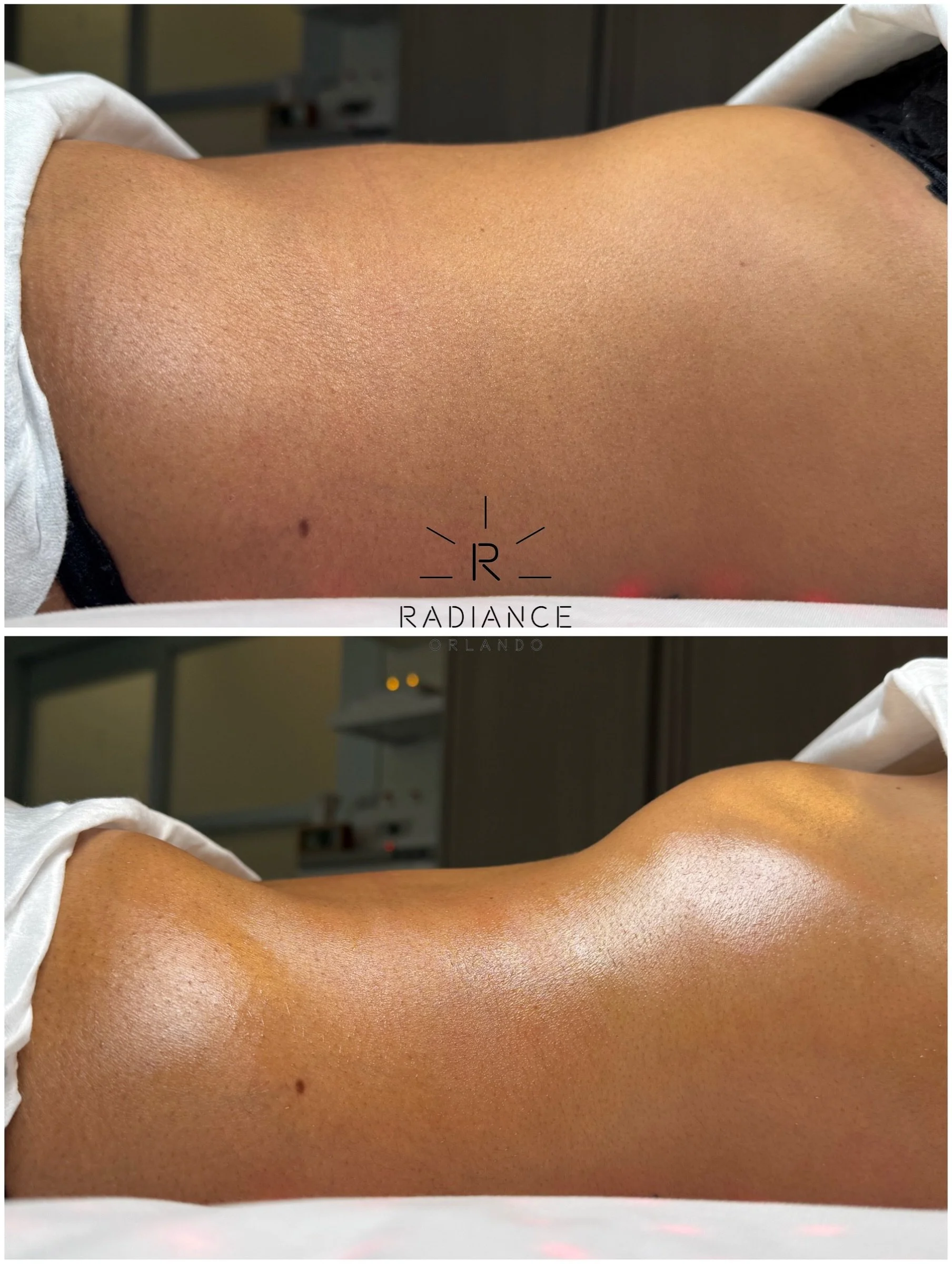 Miami, she&rsquo;s ready for you! 🌴☀️

One Extreme Stomach Sculpt session and this beauty is officially Miami ready! 🔥

No surgery. No downtime. Just our signature sculpting technique doing what we love most.

Have a trip coming up? Your before &am